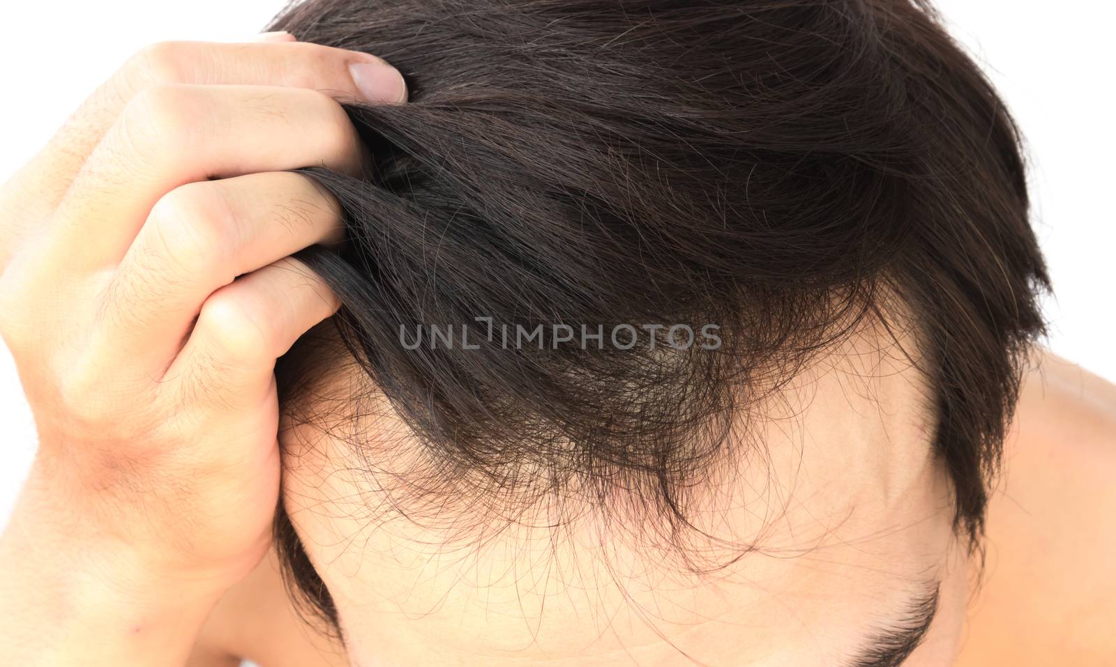 Young man serious hair loss problem for health care medical and  by pt.pongsak@gmail.com