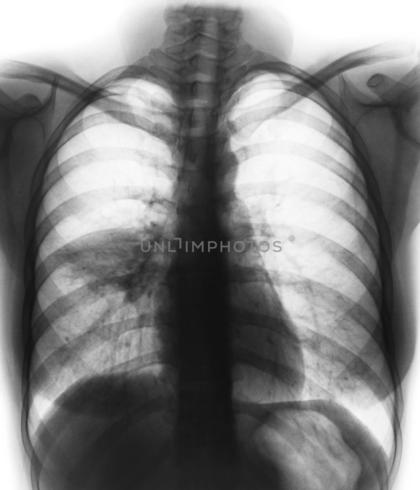 Pneumonia ( film chest x-ray show alveolar infiltrate at right middle lung ) by stockdevil
