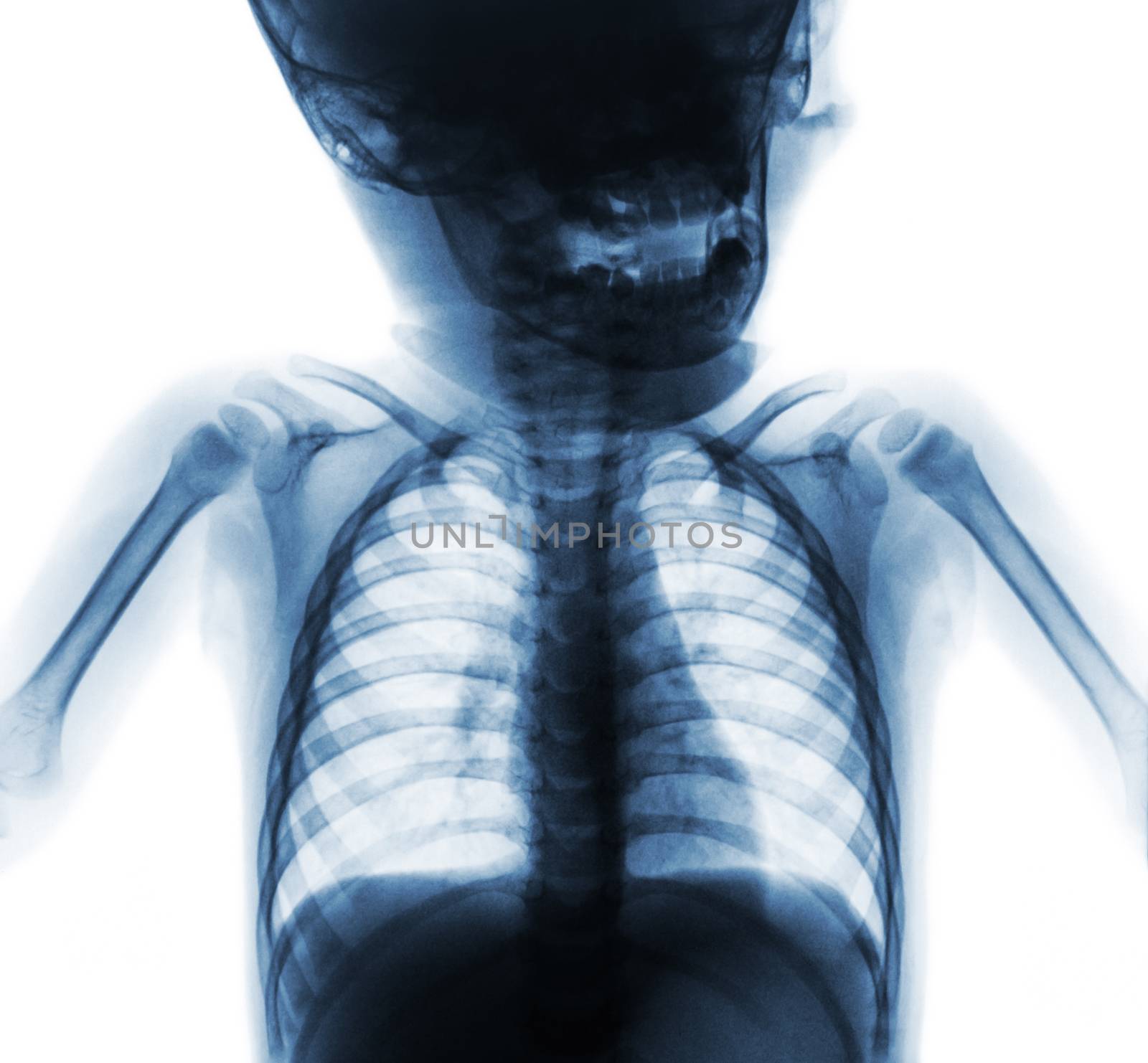 Film x-ray normal chest of baby . Upper half of body . Front view by stockdevil