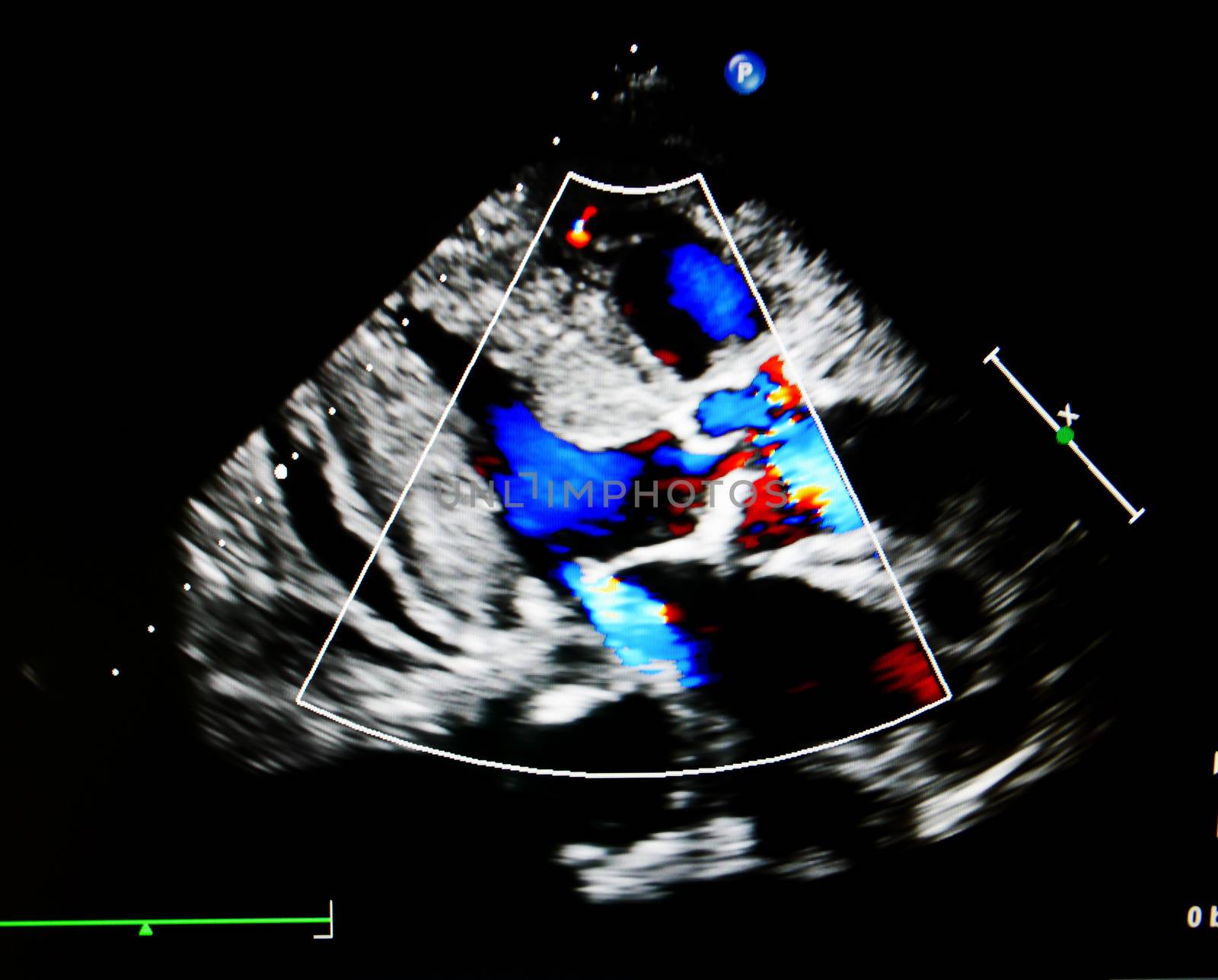 Flow color mode show jet from aortic and mitral valve regurgitation