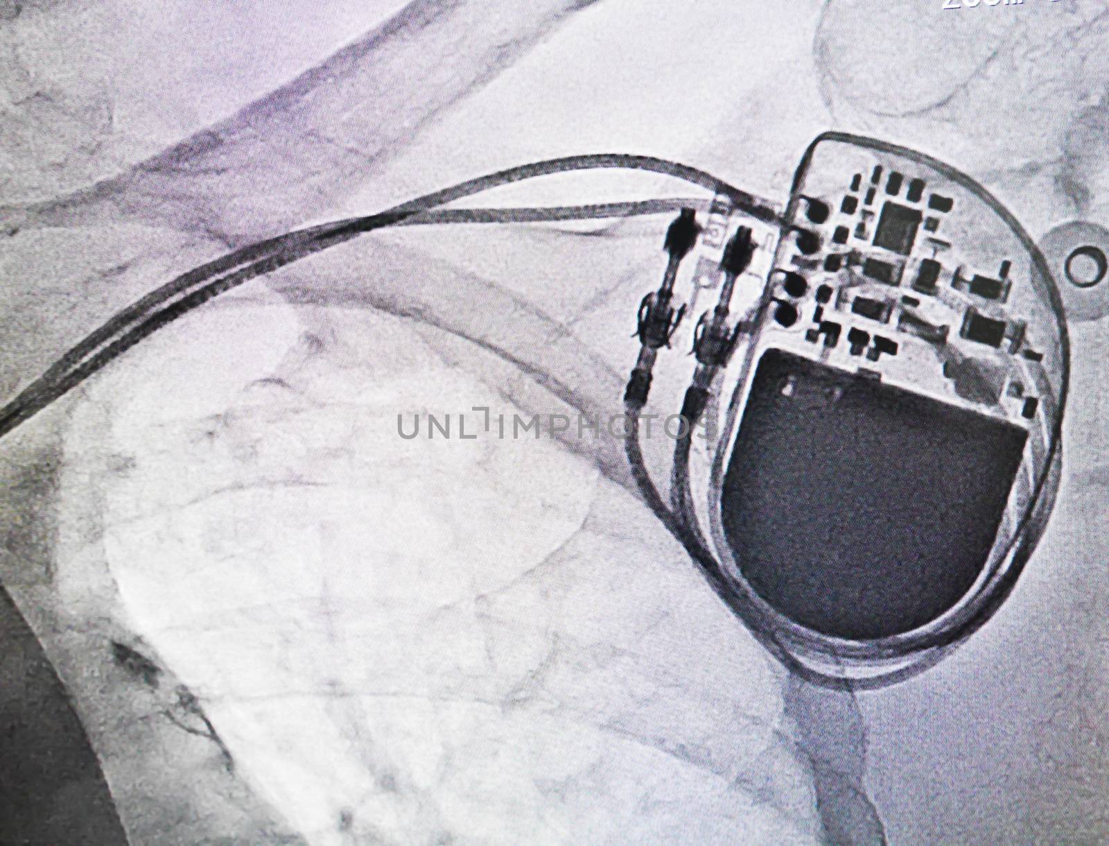 Permanent pacemaker x-ray image in cardiac catheterization