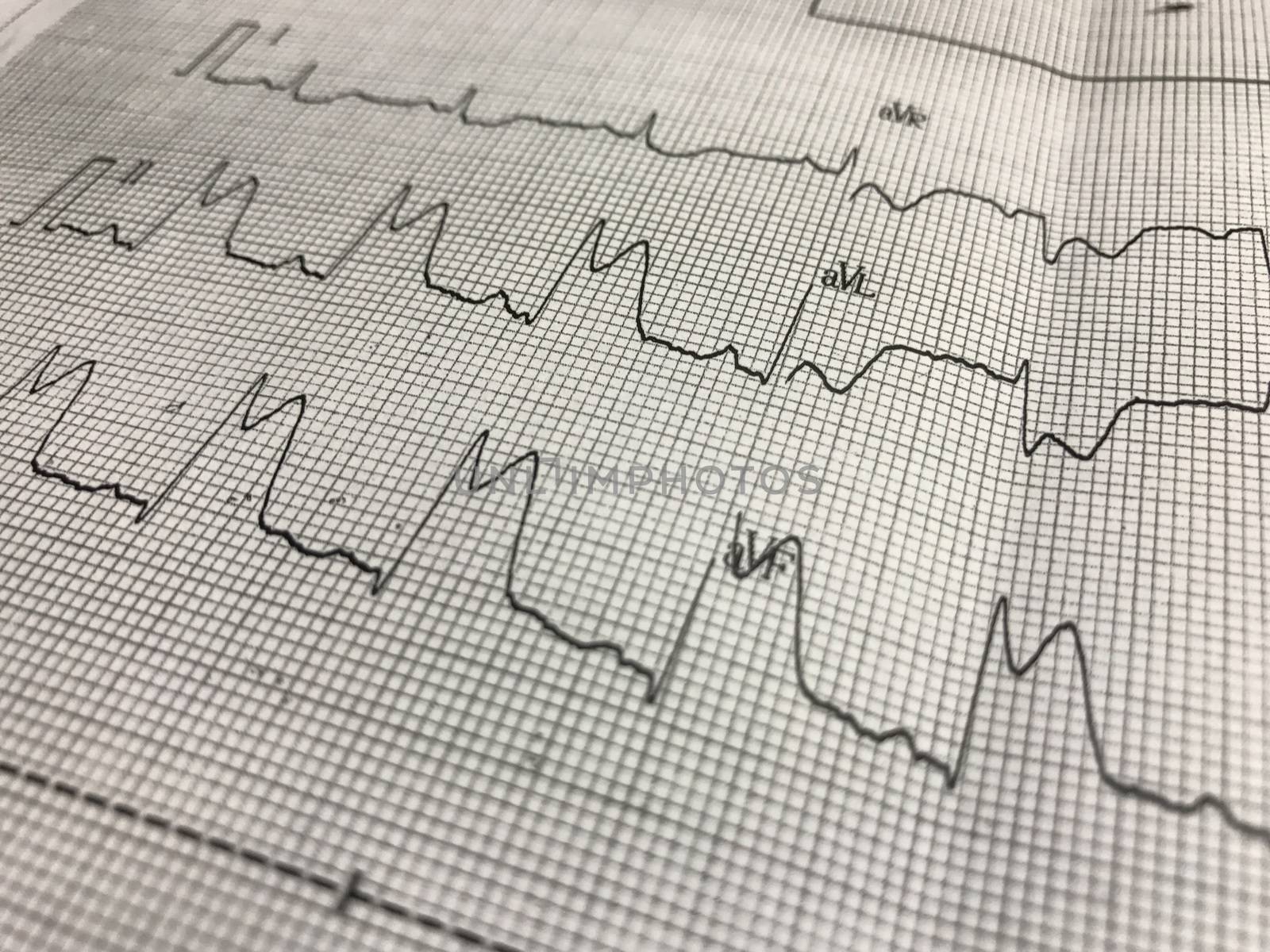 Close up ST elevation in leadI ll,lll on ECG paper