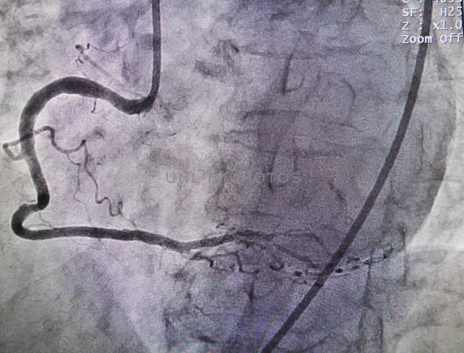 Right coronary artery from x-ray in cardiac catheterization laboratory