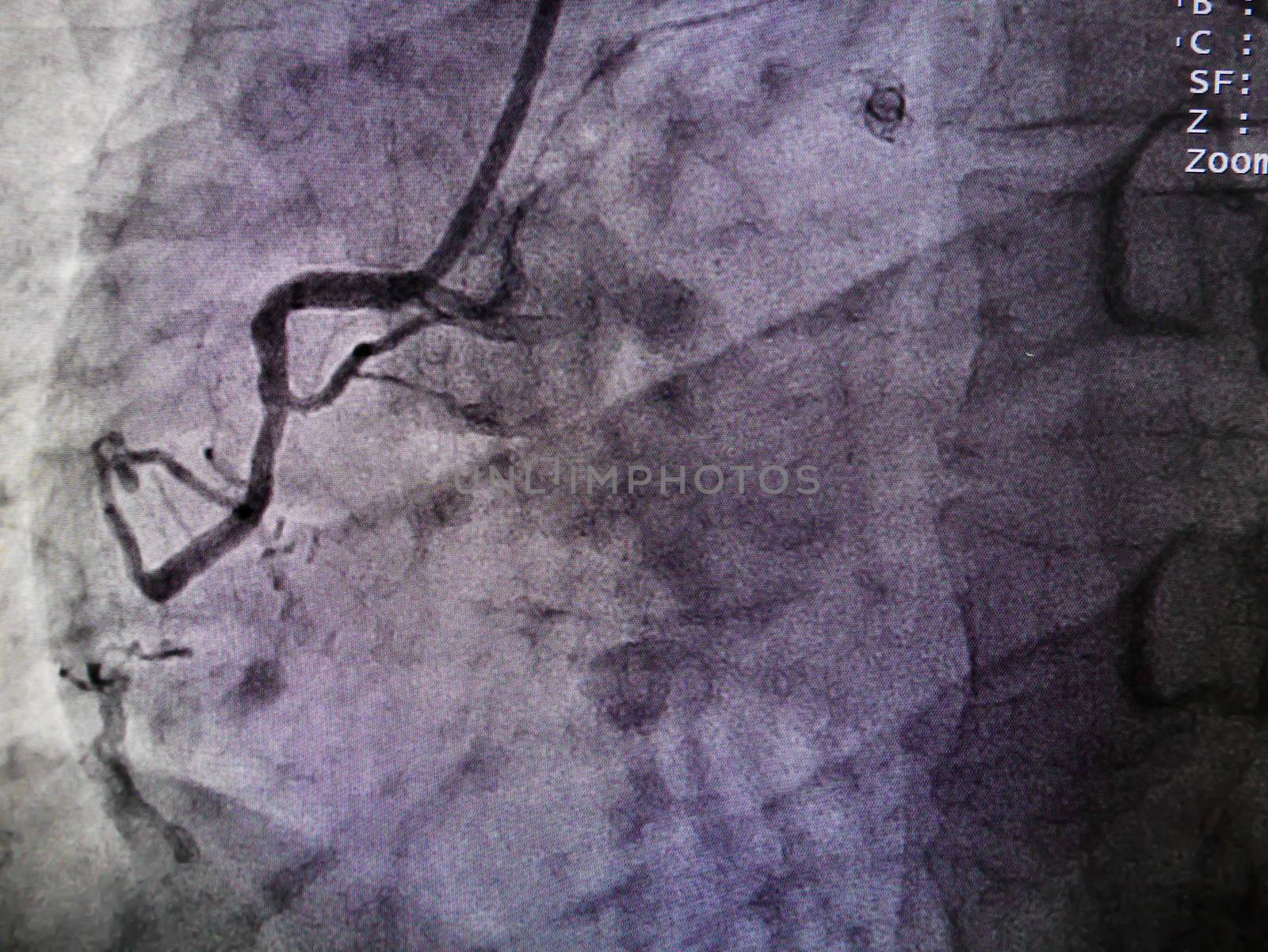 STEMI at right coronary artery from x-ray in cardiac catheterization laboratory