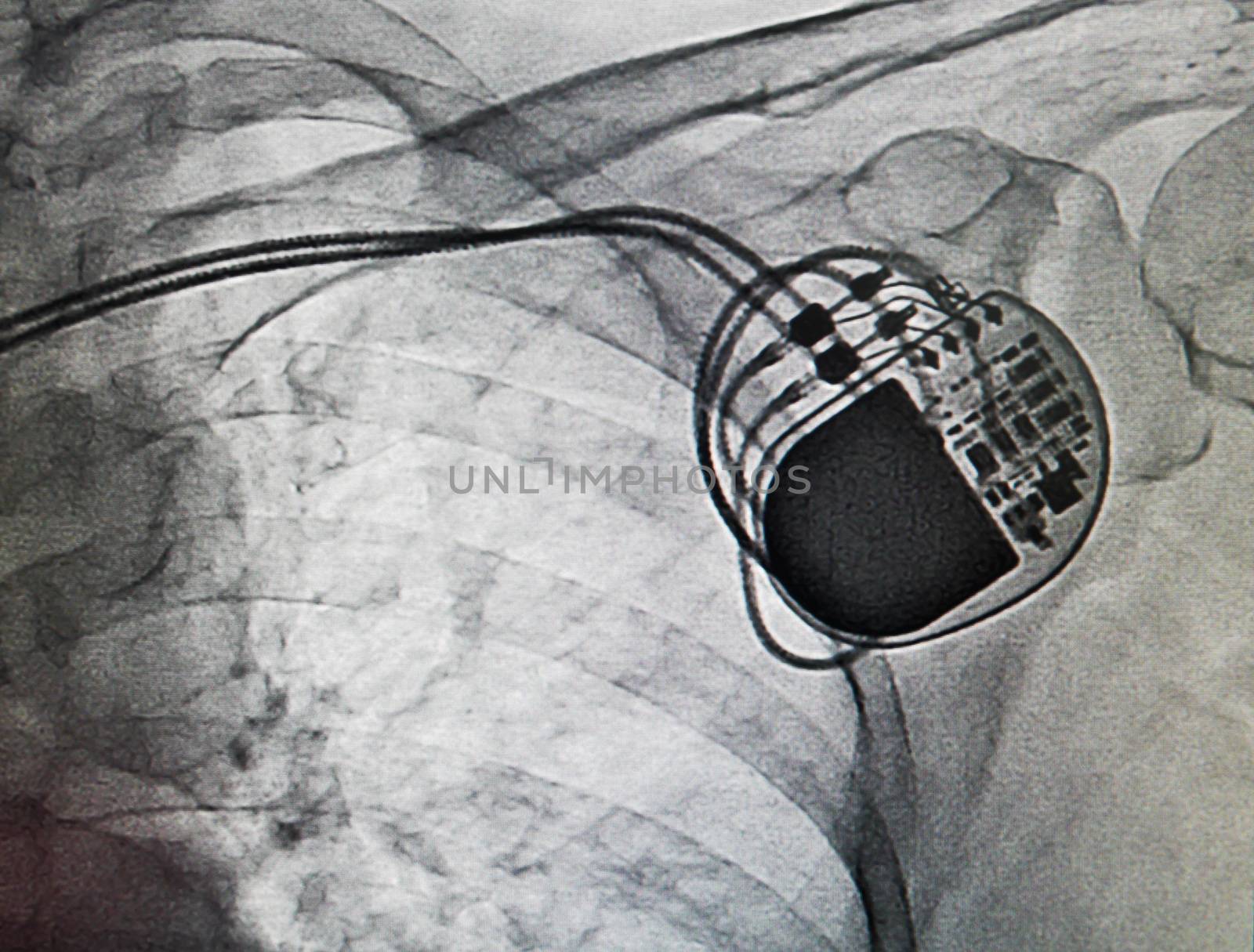 DDDR pacemaker in x-ray image in cardiac catheterization laboratory