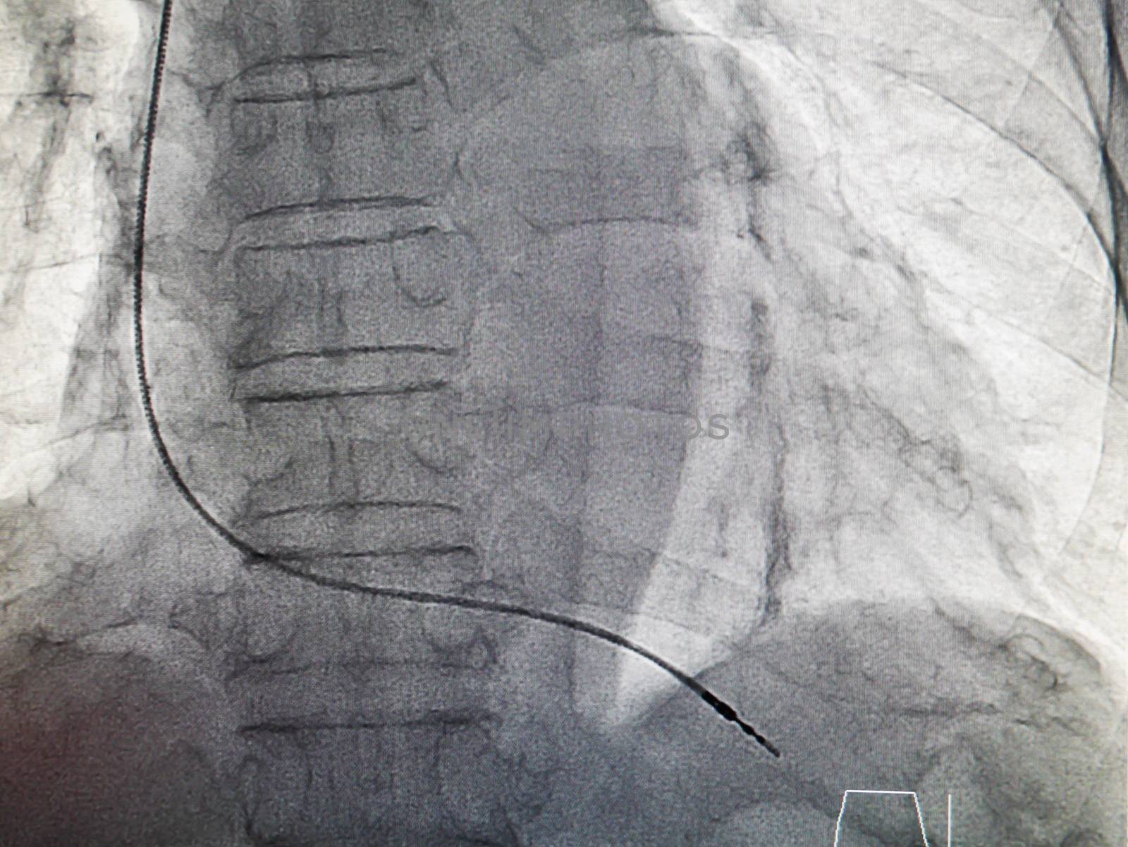 VVIR pacemaker cable in x-ray image in cardiac catheterization laboratory