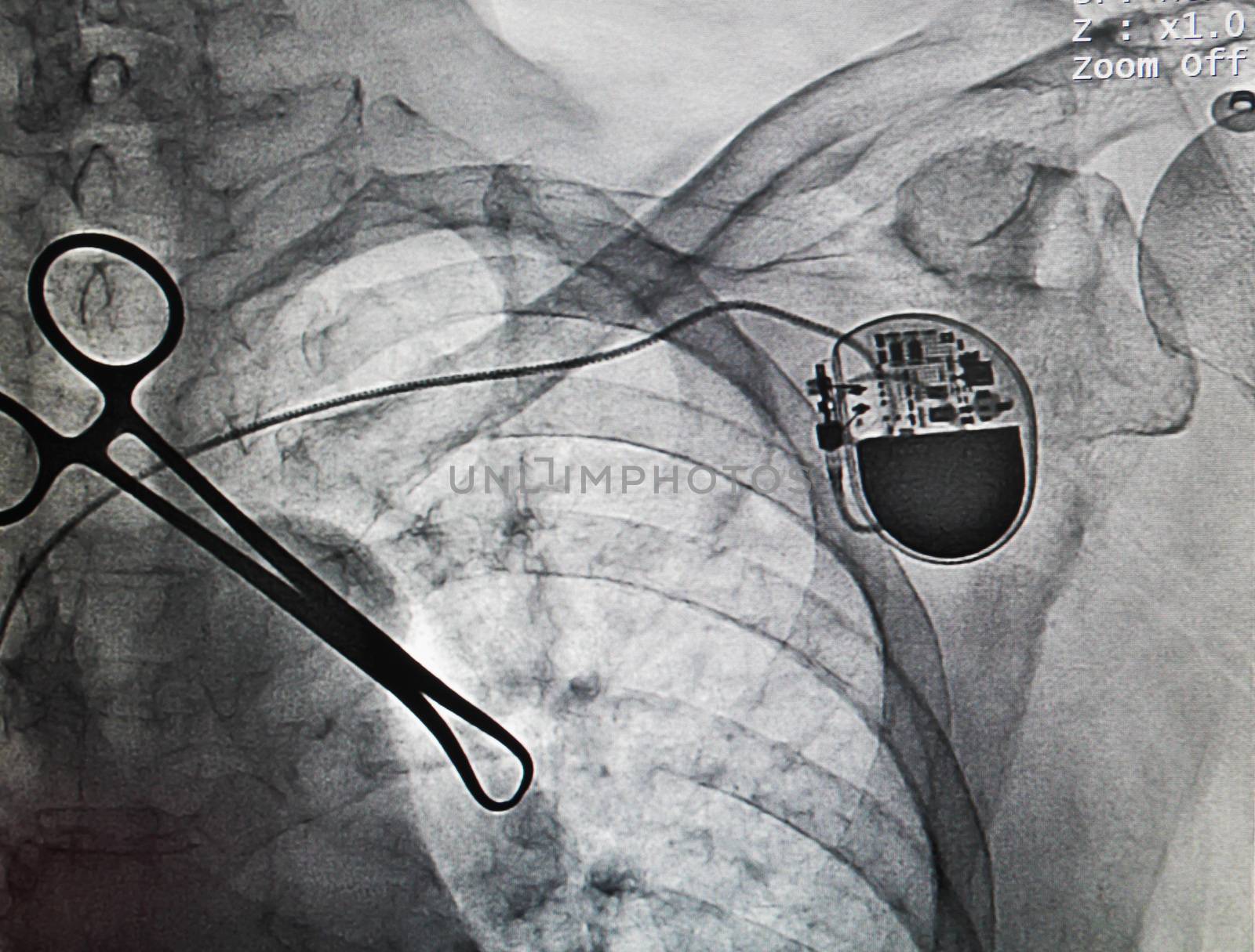VVIR pacemaker in x-ray image in cardiac catheterization laboratory