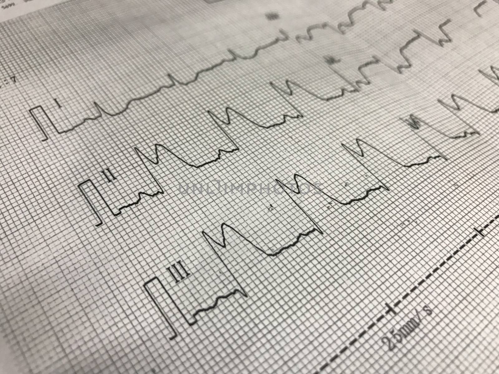 Close up ST elevation in leadI ll, lll on ECG paper