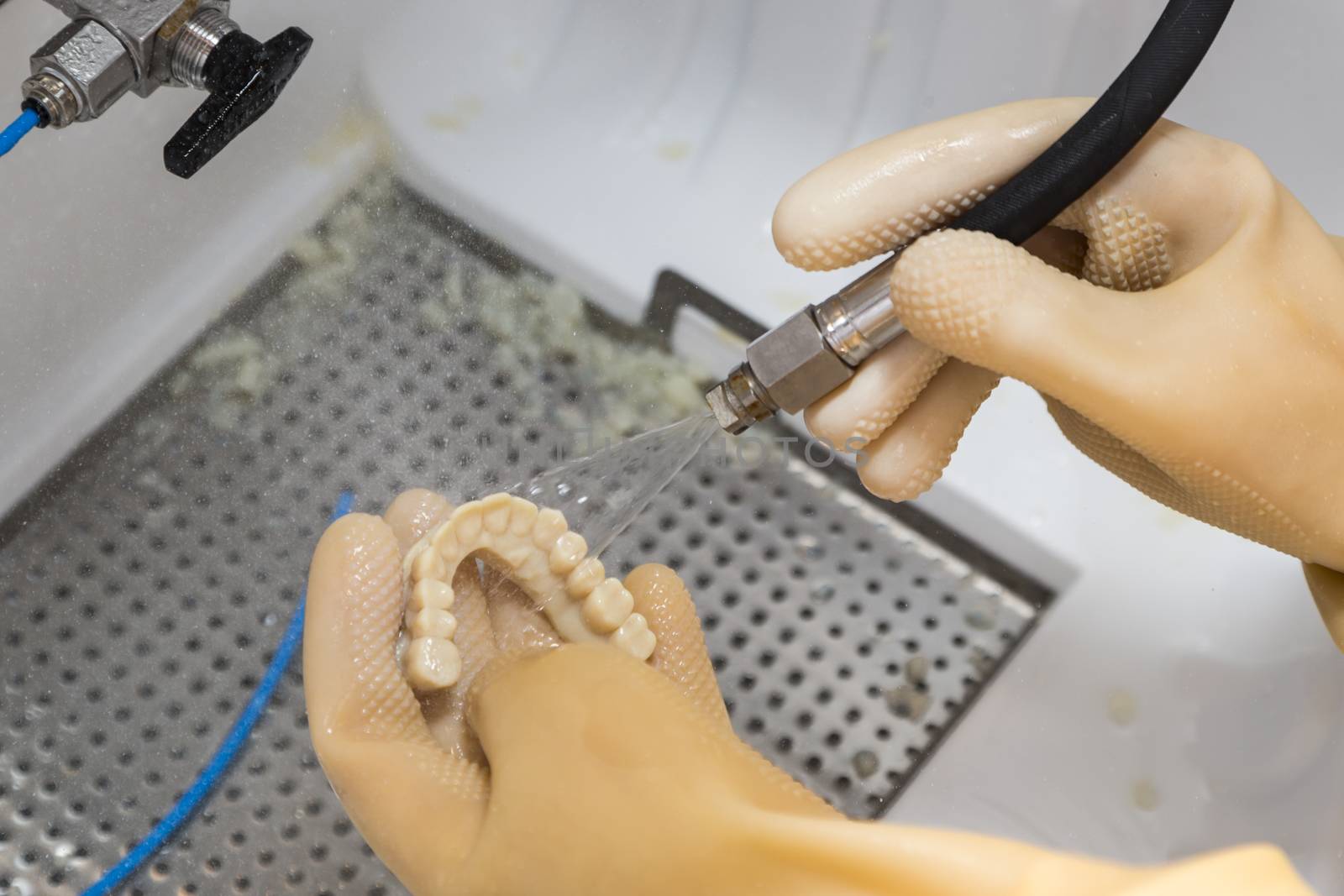 Dental Technician Cleans 3D Printed Dental Implant Bridge In Lab With Water.