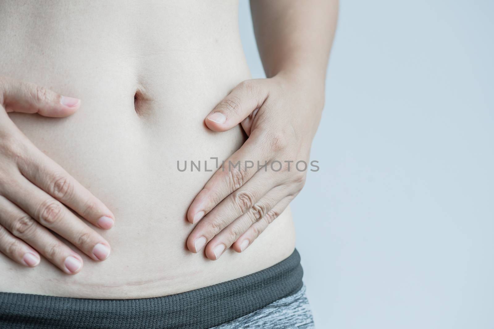 Closeup of woman showing on her belly dark scar from a cesarean section.