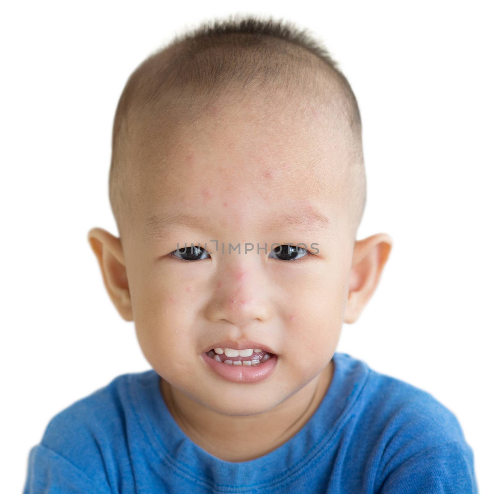 Two years old Asian toddler with red rashes on face. Portrait of young boy isolated on white background.