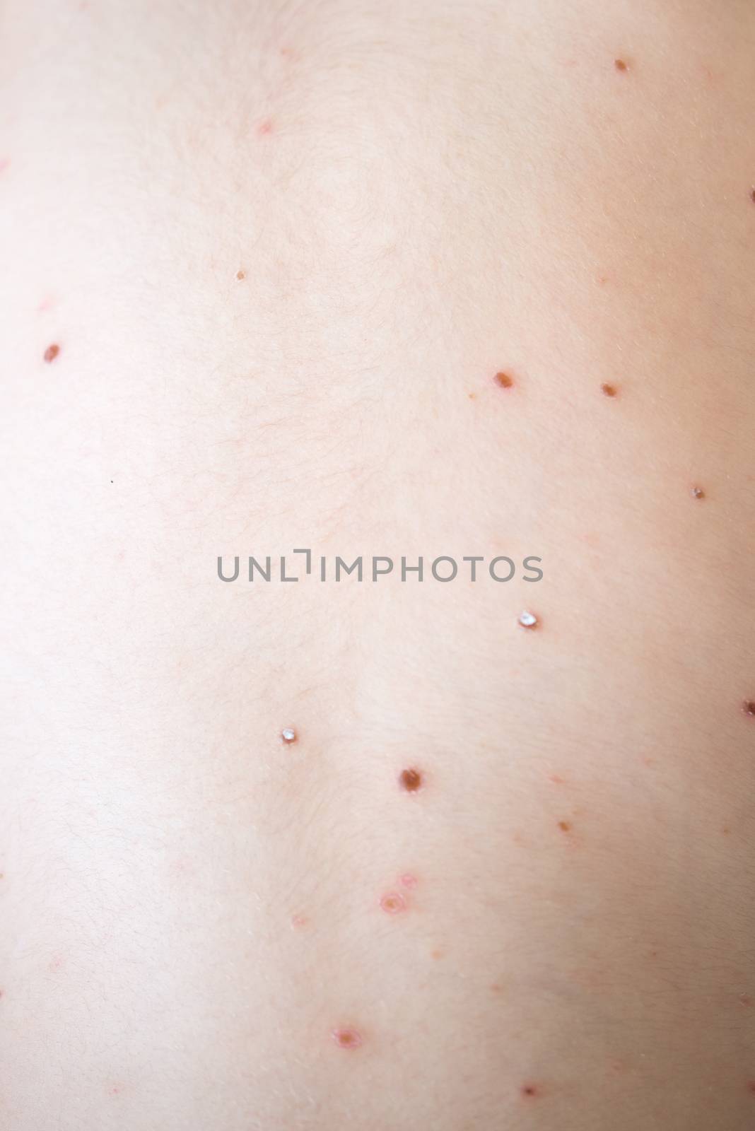 Chickenpox on the body of a young child, skin infection