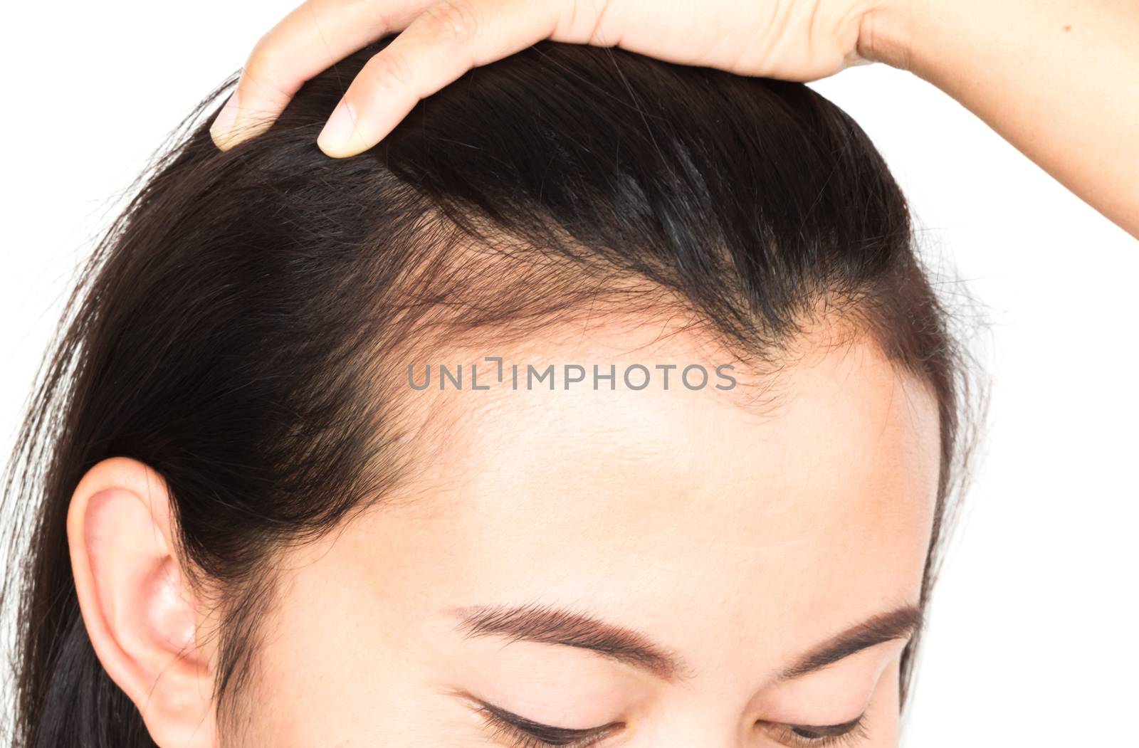 Woman serious hair loss problem for health care shampoo and beau by pt.pongsak@gmail.com