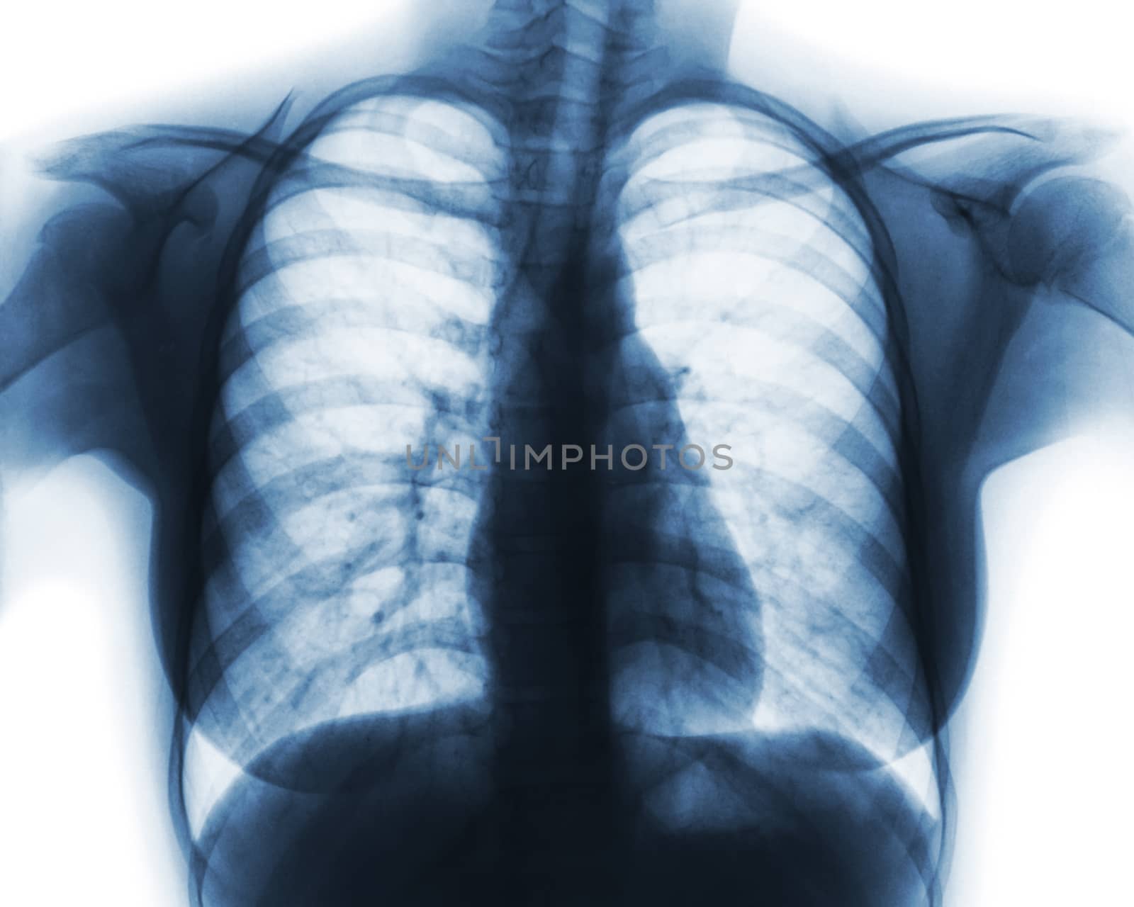 Film chest x-ray of normal woman chest by stockdevil