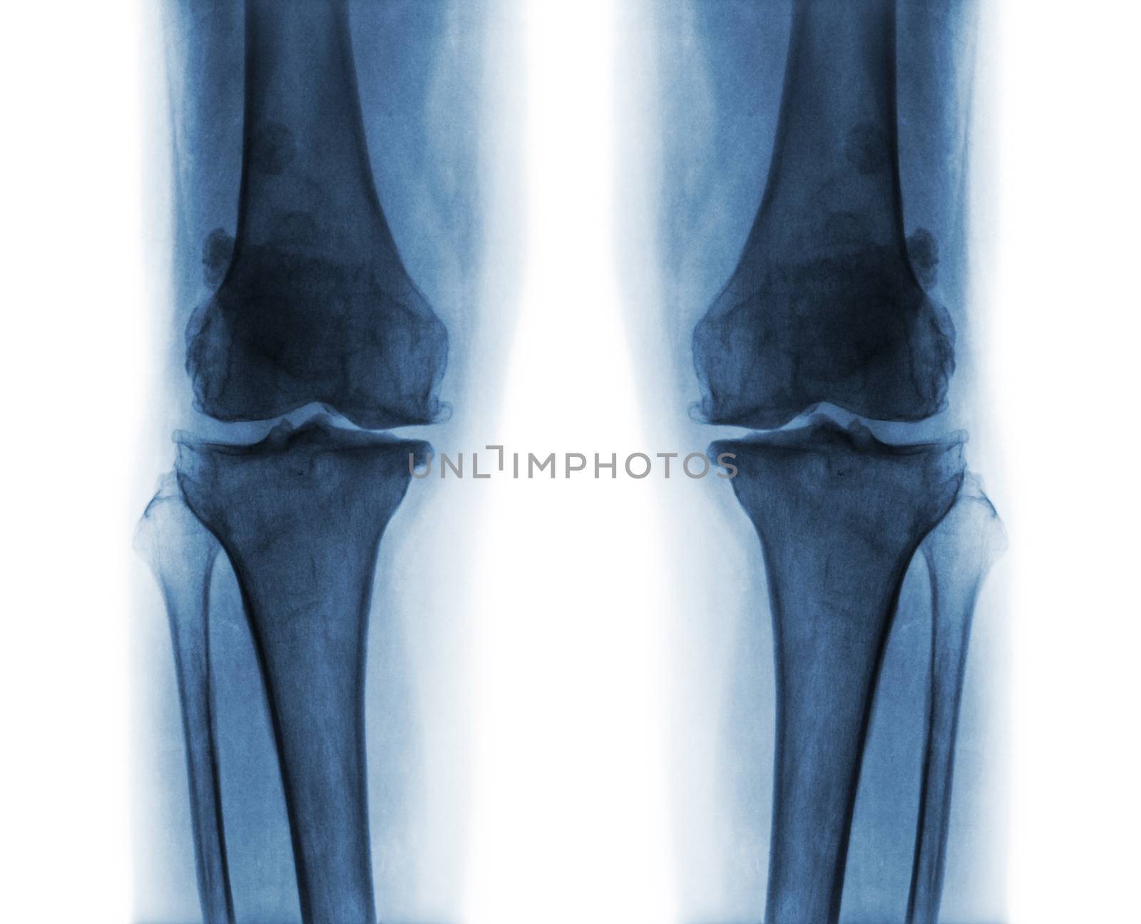 Osteoarthritis both knee . by stockdevil