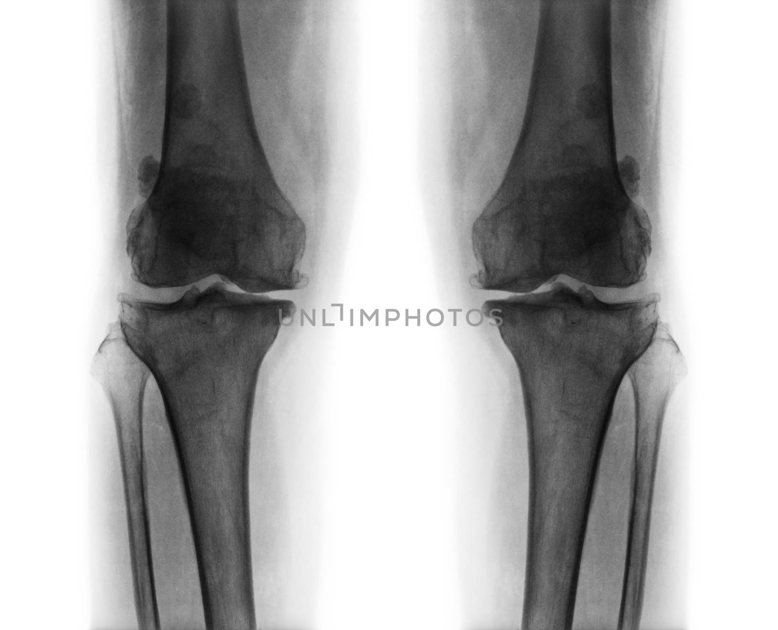 Osteoarthritis both knee . film x-ray AP ( anterior - posterior ) of knee show narrow joint space . osteophyte ( spur ) . subcondral sclerosis .