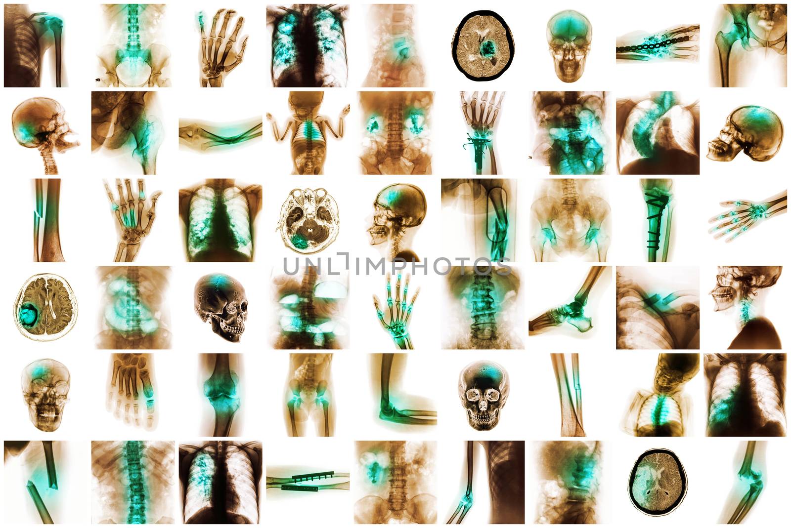 X-ray multiple disease of child and adult ( Stroke , Arthritis , Fracture , Tuberculosis , Brain tumor , Bowel obstruction , Kidney stone , Spondylosis , Spondylolisthesis , Osteoarthritis knee ,etc)