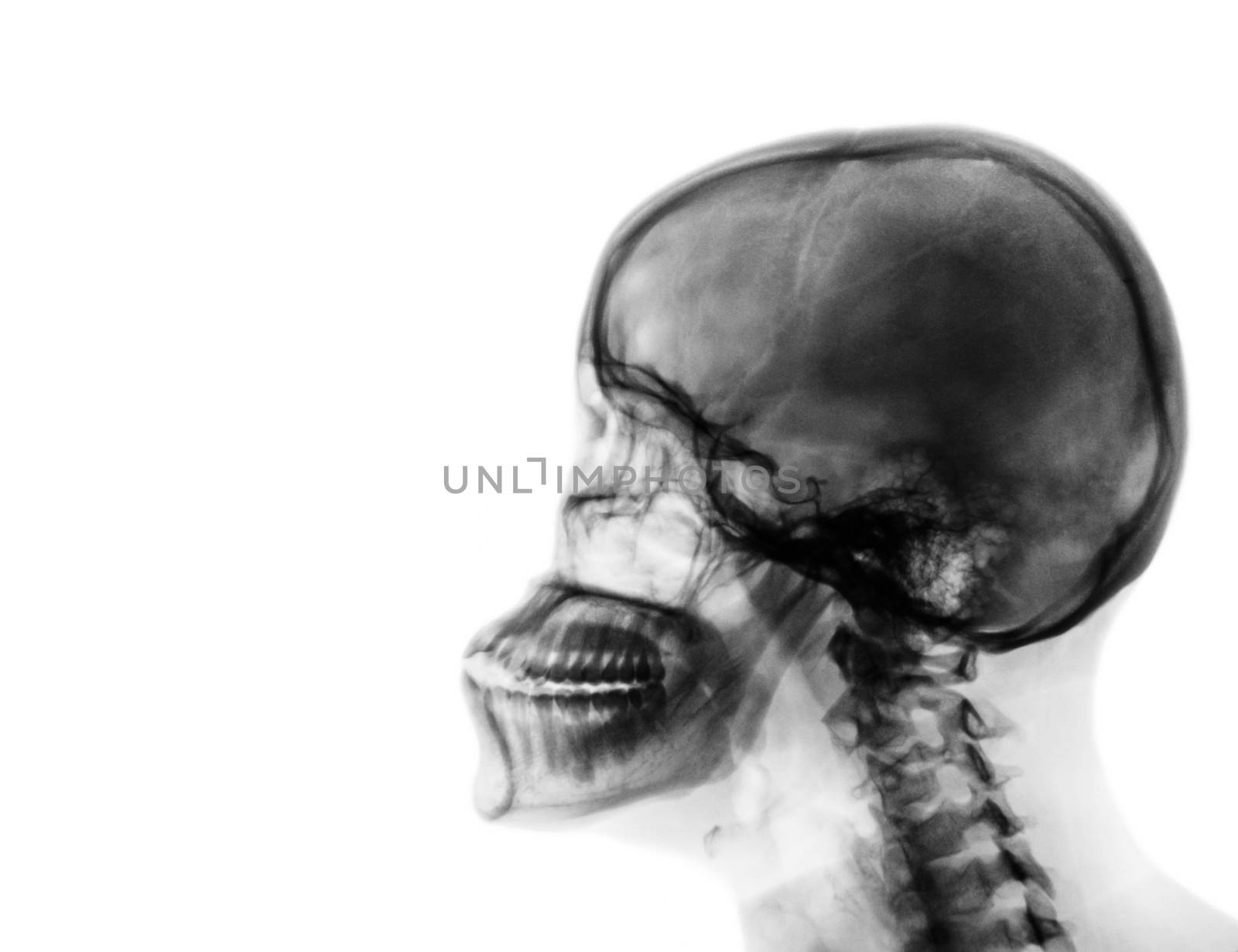 X-ray normal skull and cervical spine . Lateral view . blank area at left side .