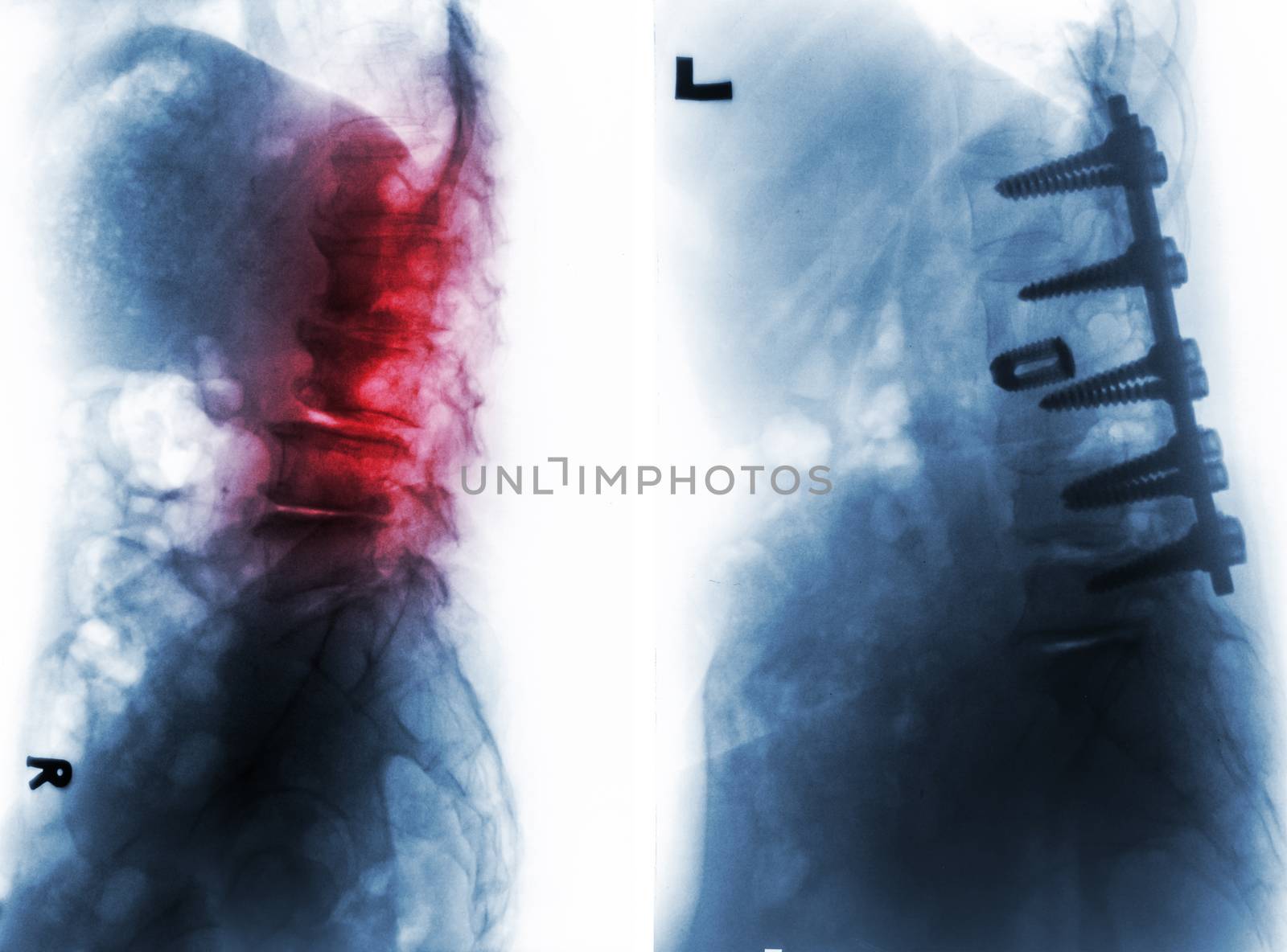 Spondylosis . Film x-ray of lumbar spine and comparison between before surgery ( left image ) and after surgery ( right image ) . Patient was operated and internal fixed . Lateral view .