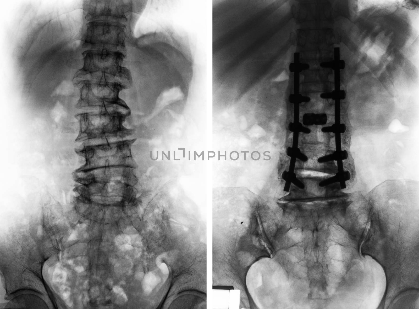 Spondylosis . Film x-ray of lumbar spine and comparison between before surgery ( left image ) and after surgery ( right image ) . Patient was operated and internal fixed . Front view .