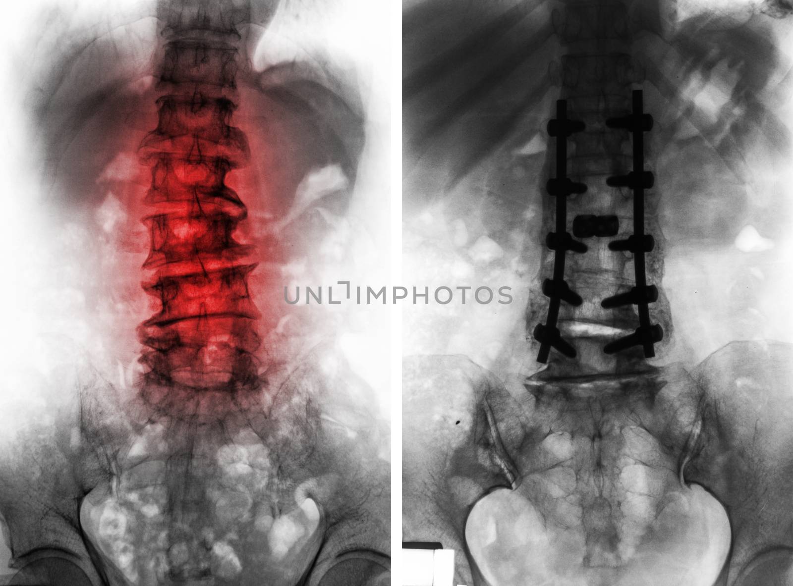 Spondylosis . Before and After surgery by stockdevil