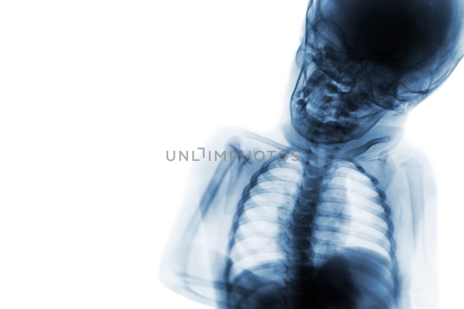X-ray upper half body of child and blank area at left side by stockdevil