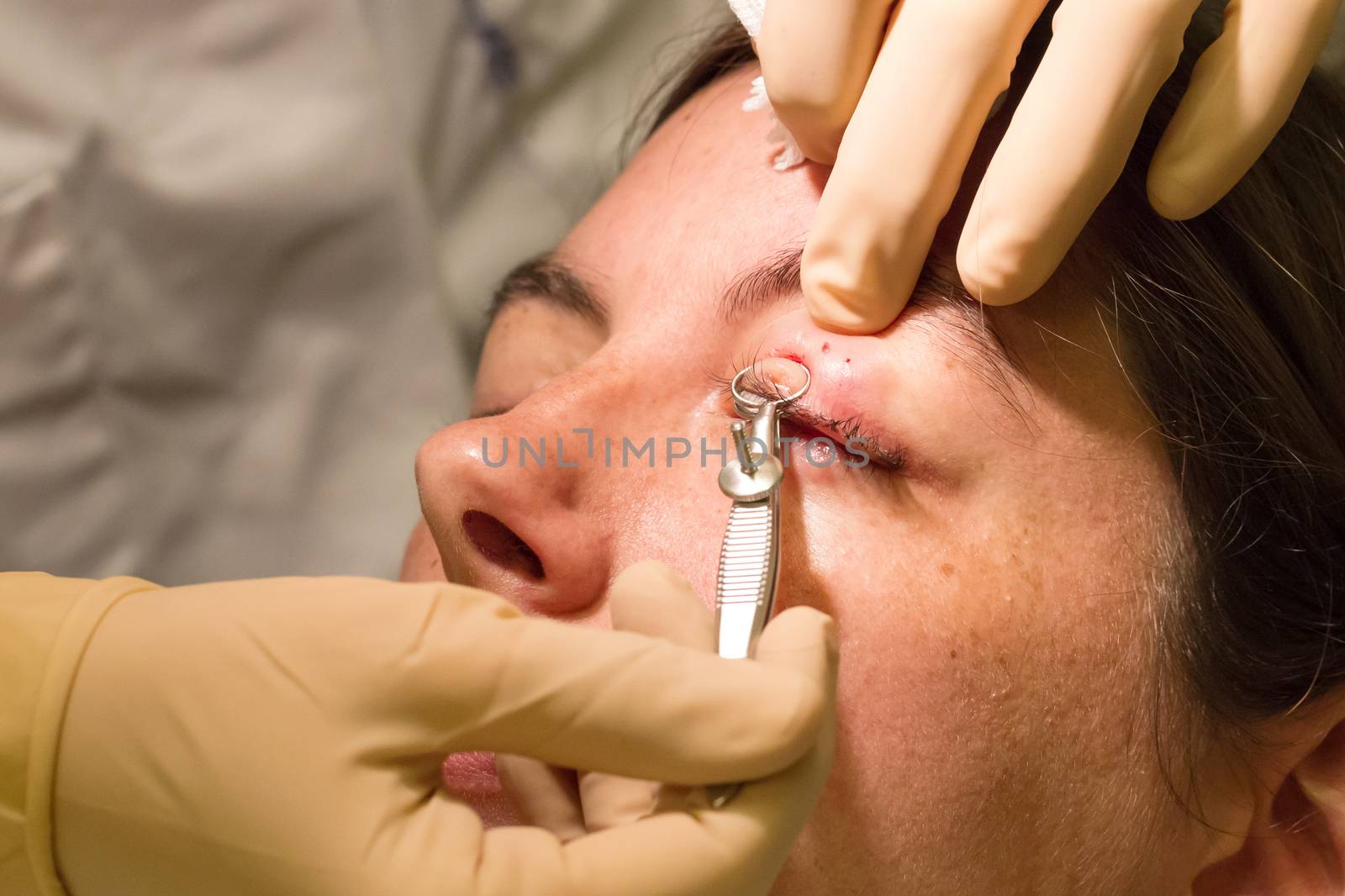 Healthcare concept - Chalazion during eye examination and operat by michaklootwijk