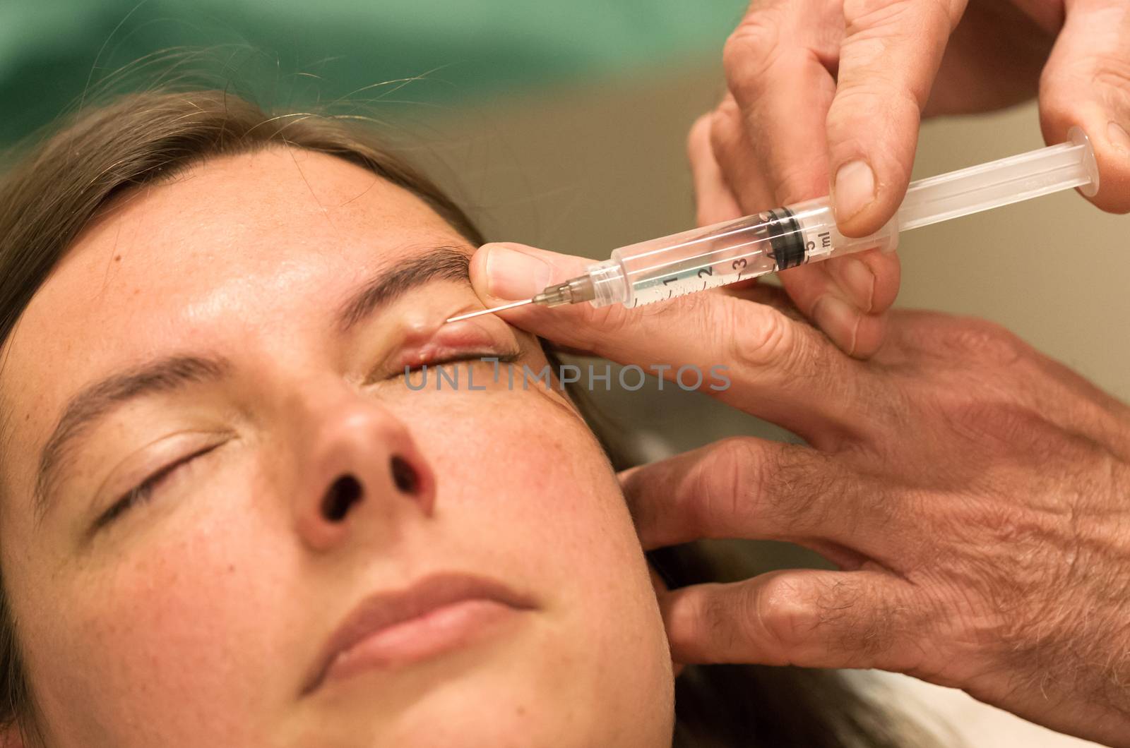 Healthcare concept - Anesthesia - Chalazion during eye examinati by michaklootwijk