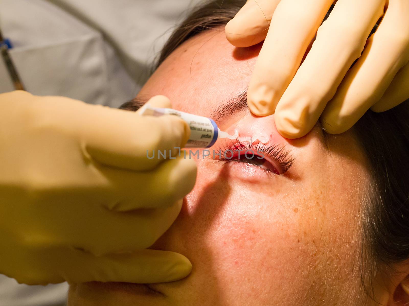 Healthcare concept - Medicine on eye - Chalazion during eye exam by michaklootwijk