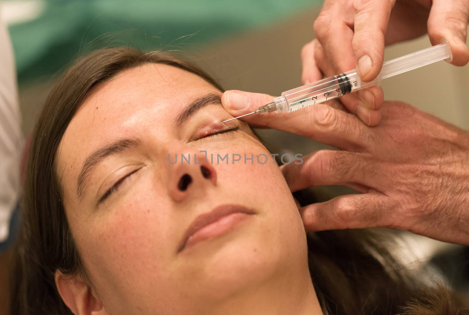 Healthcare concept - Anesthesia - Chalazion during eye examination and operation - Female