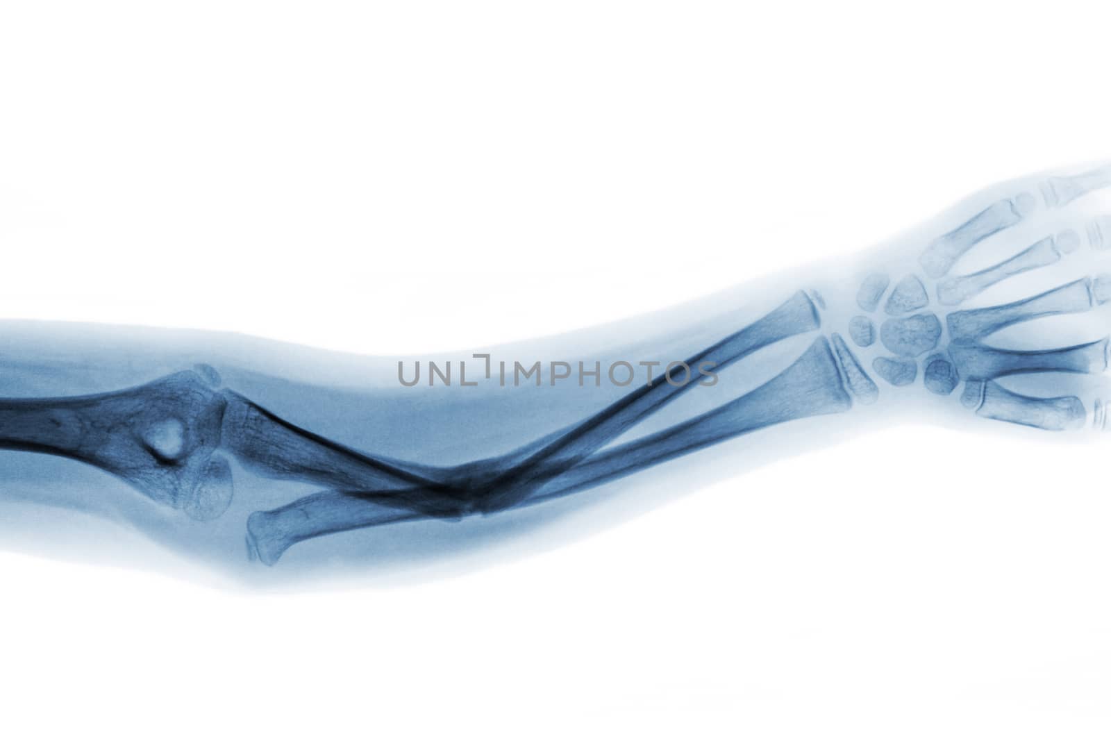 Film x-ray forearm AP show fracture shaft of ulnar bone by stockdevil