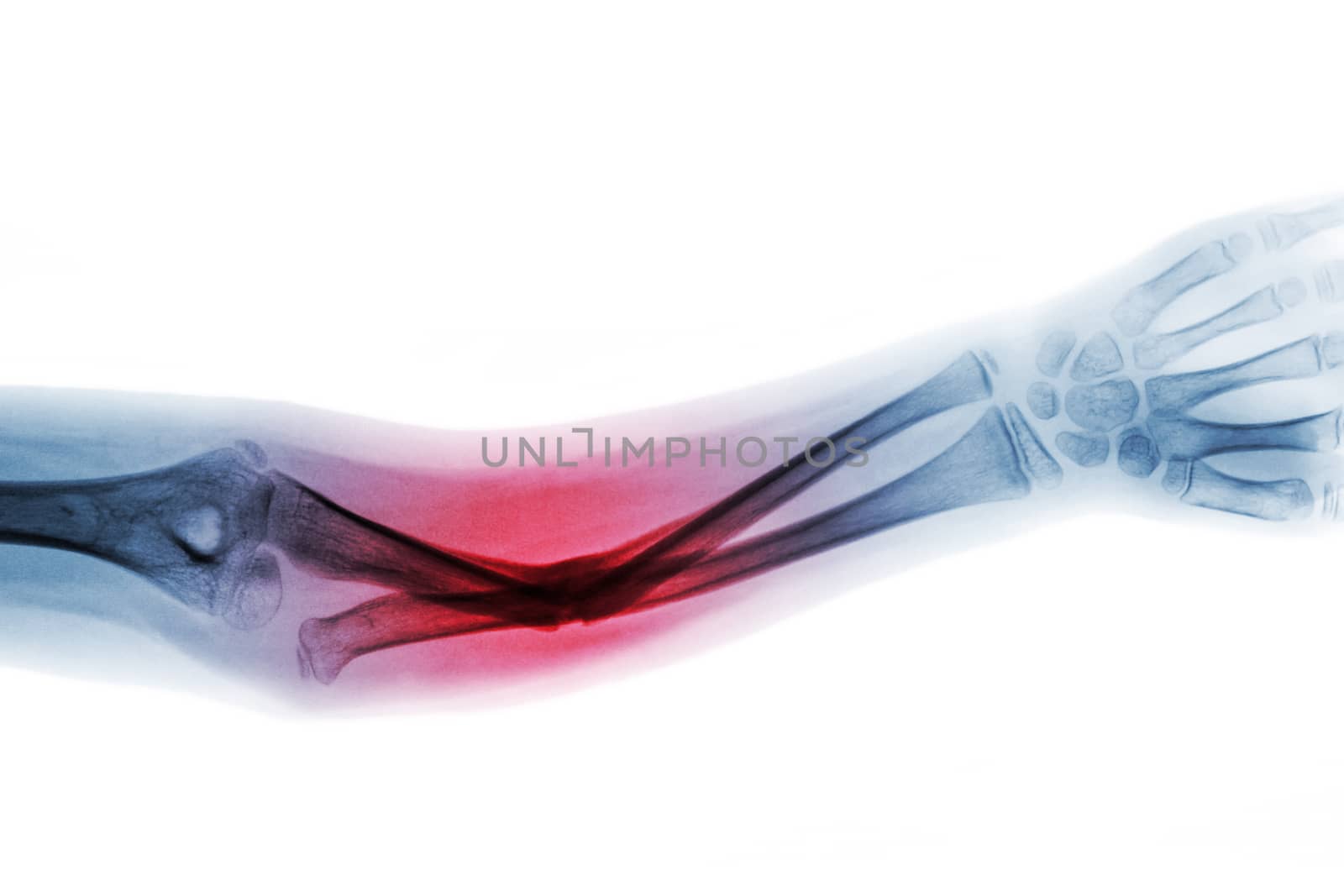 Film x-ray forearm AP show fracture shaft of ulnar bone by stockdevil