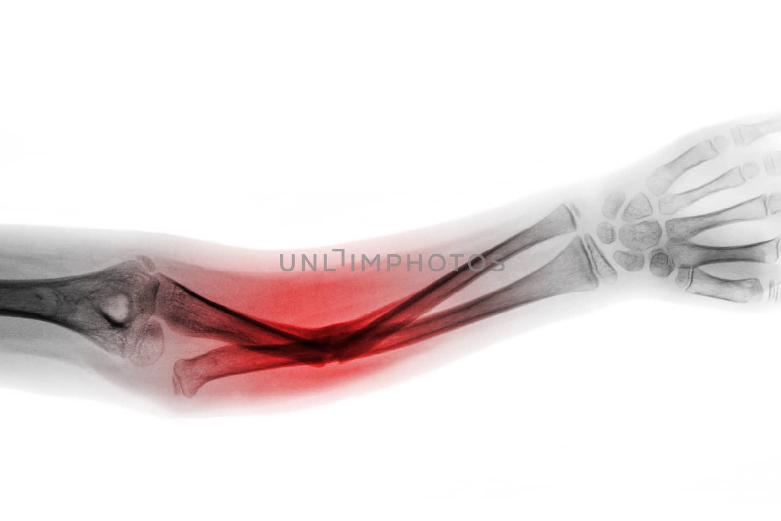 Film x-ray forearm AP show fracture shaft of ulnar bone .