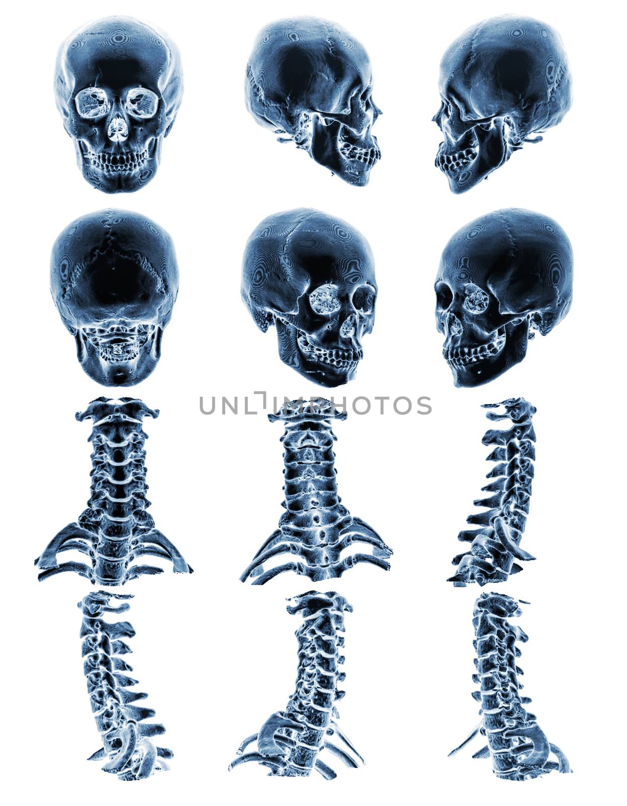 CT scan ( Computed tomography ) with 3D graphic show normal human skull and cervical spine . Multiple view .