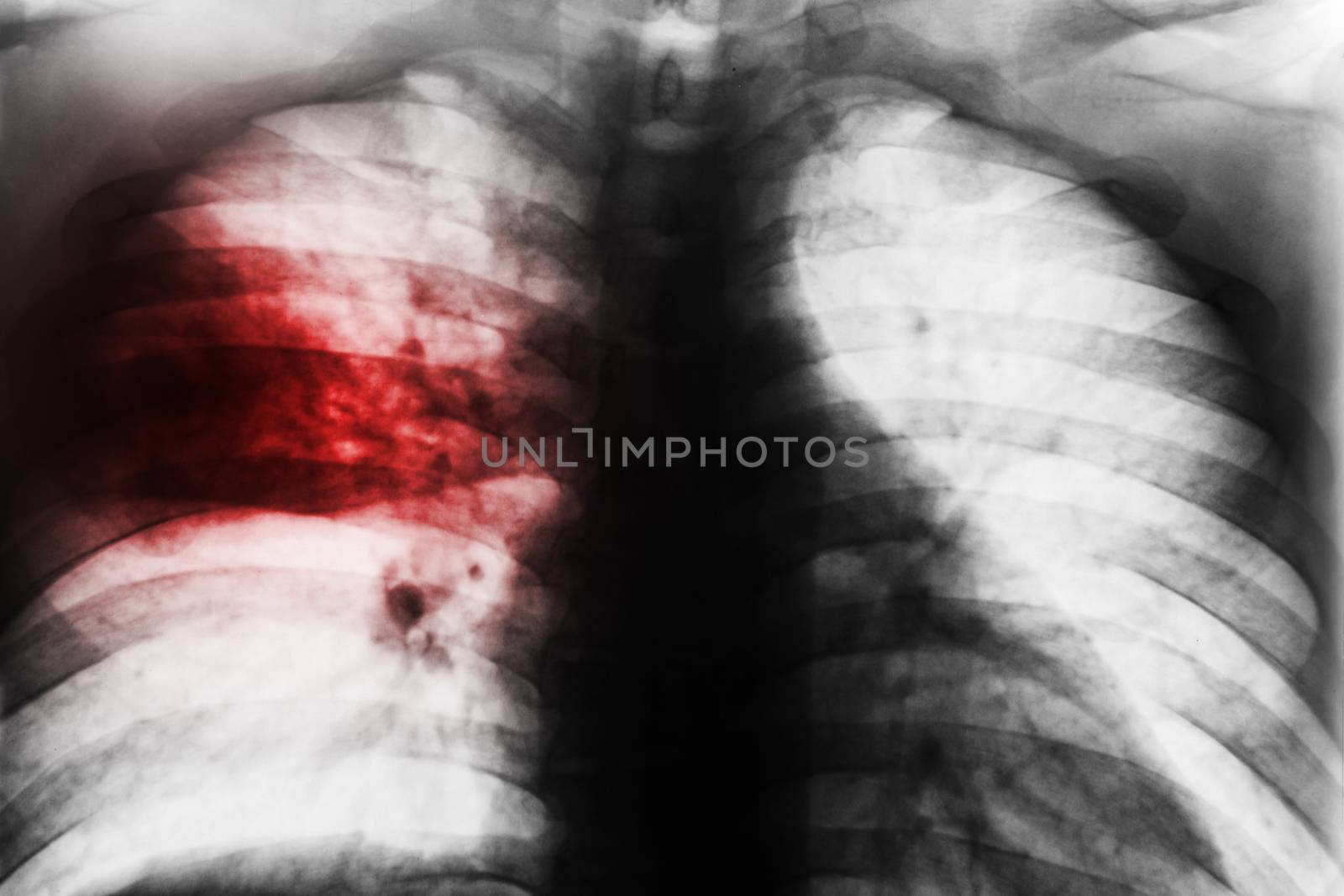 Lobar Pneumonia . Film chest x-ray show patchy infiltrate at right middle lung from Mycobacterium tuberculosis infection ( Pulmonary tuberculosis ) .