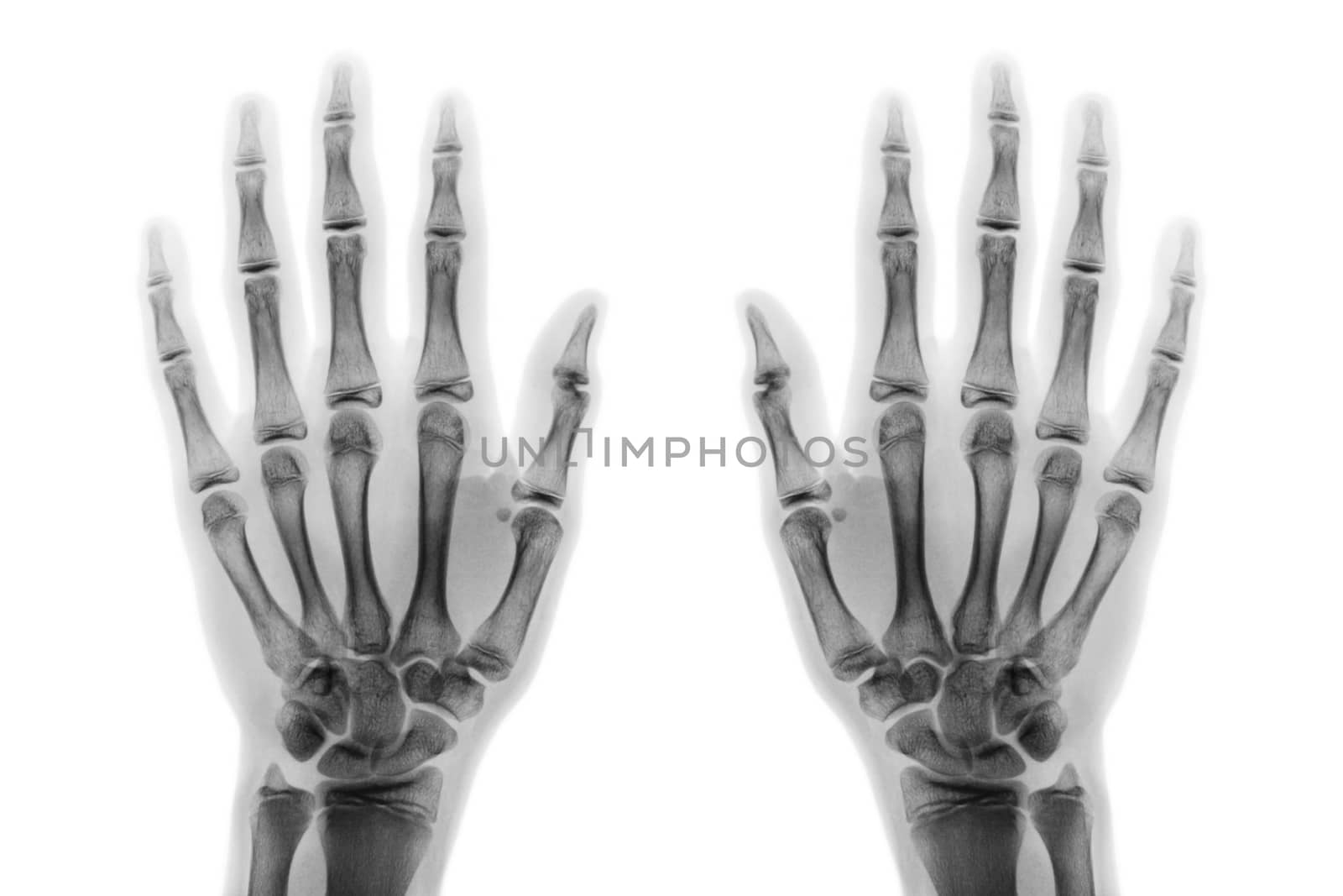 Film x-ray both hand AP show normal human hands on white background ( isolated ) .