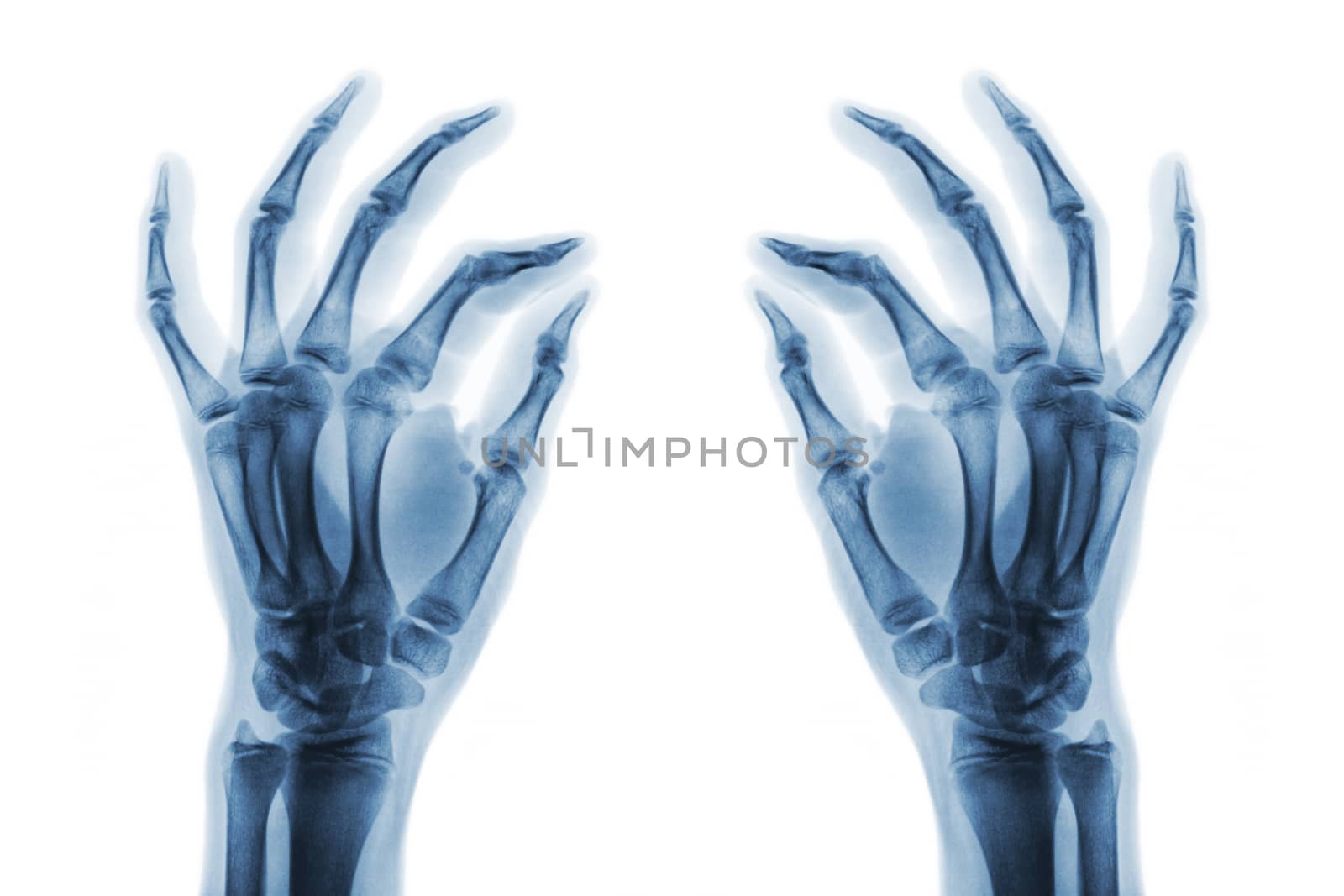 X-ray normal human hands on white background . Oblique view by stockdevil