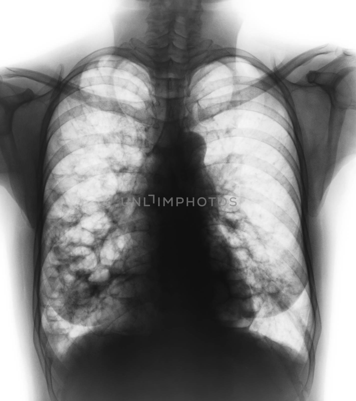 Bronchiectasis . X-ray chest show multiple lung bleb and cyst due to chronic infection . Front view by stockdevil