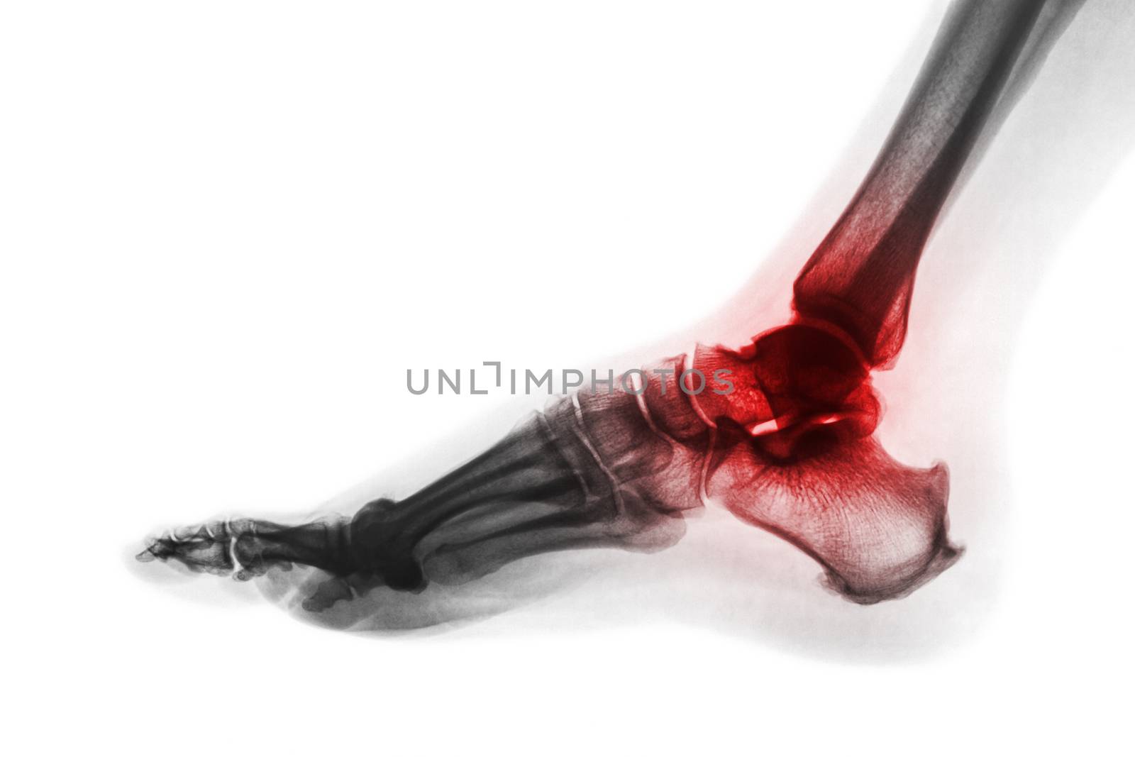 Arthritis of ankle . X-ray of foot . Lateral view . Invert color style . Gout or Rheumatoid concept .
