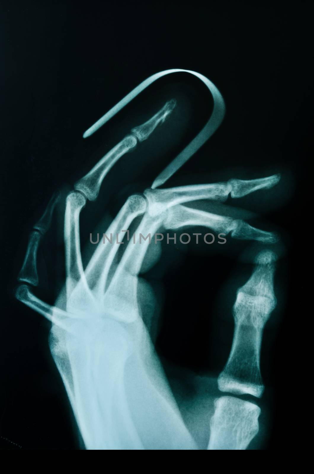 X-ray of broken finger. by Gamjai