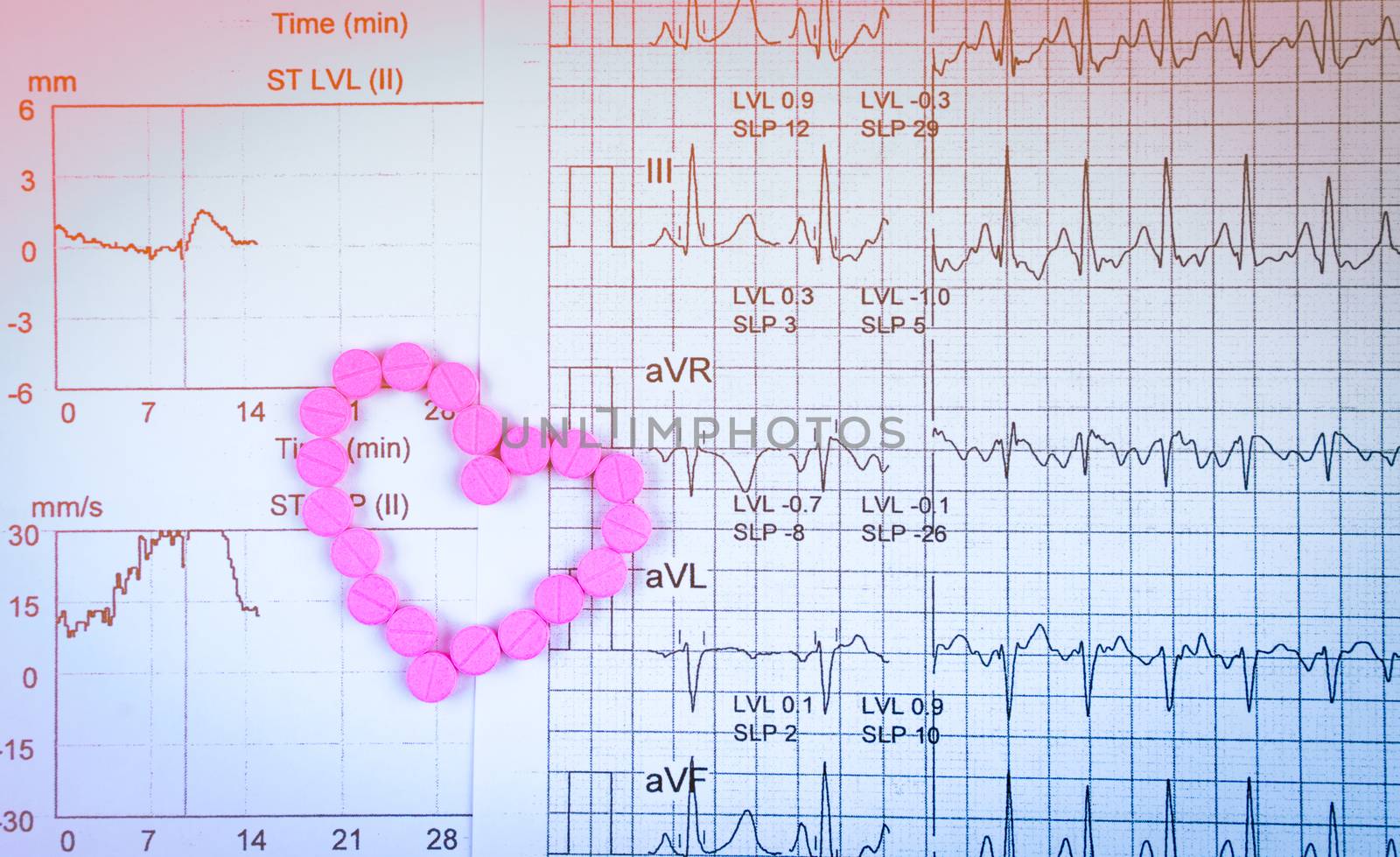 EKG or ECG (Electrocardiogram) graph report paper. EST ( Exercise Stress Test ) result and pink heart shape made from pills. Package promotion for heart check up in senior or elderly people concept. by Fahroni
