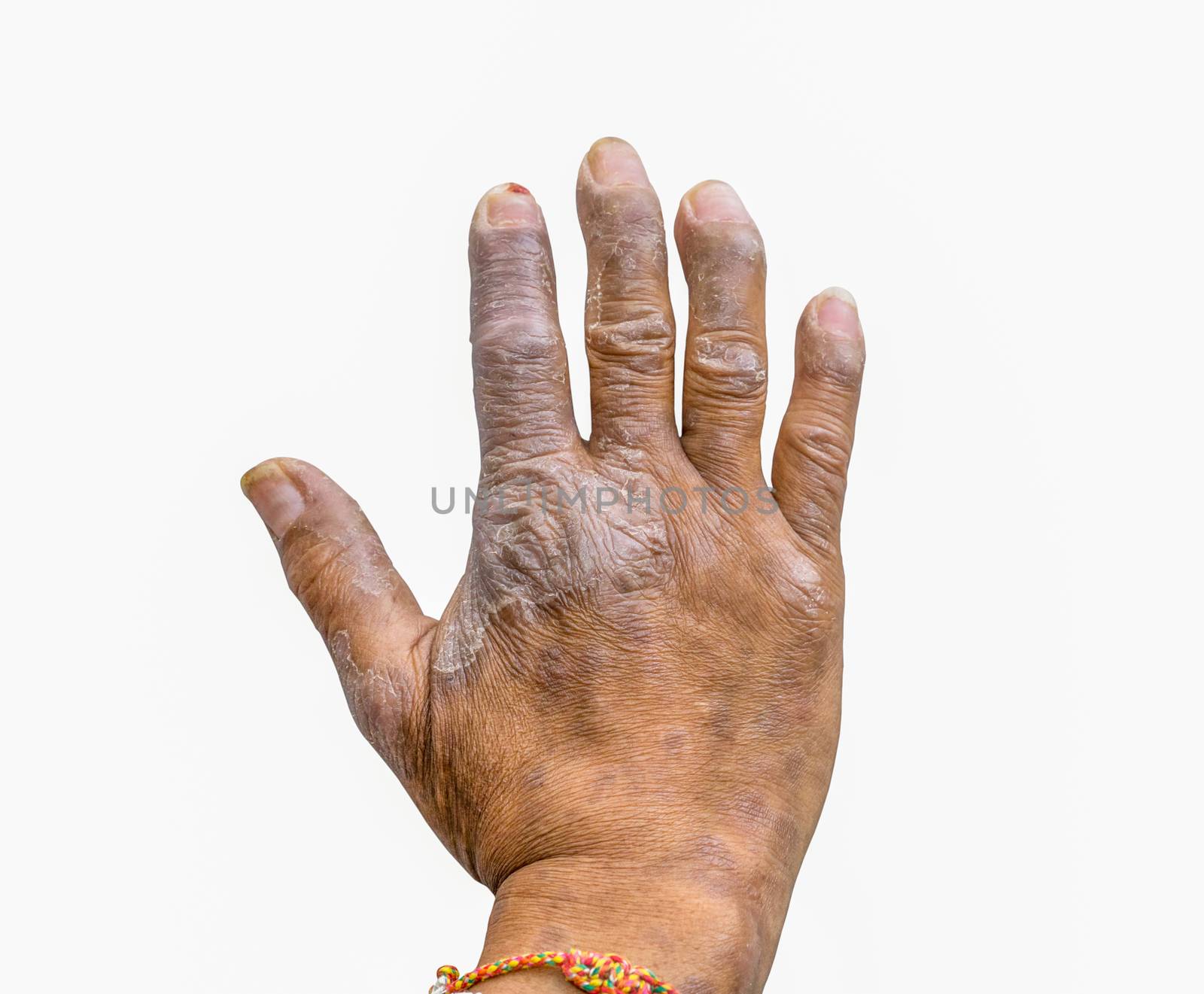 Closeup of psoriasis on the hands of farmers isolated on white background, dermatology skin disease. Psoriasis fingers deformity.