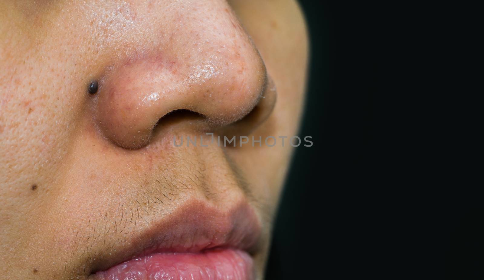 Black mole behind nose need CO2 Laser to removal. Blackheads acne on Asian woman nose. Comedones and large pores skin need AHA, BHA or benzoyl peroxide. Excess male hormone cause of female mustache. by Fahroni