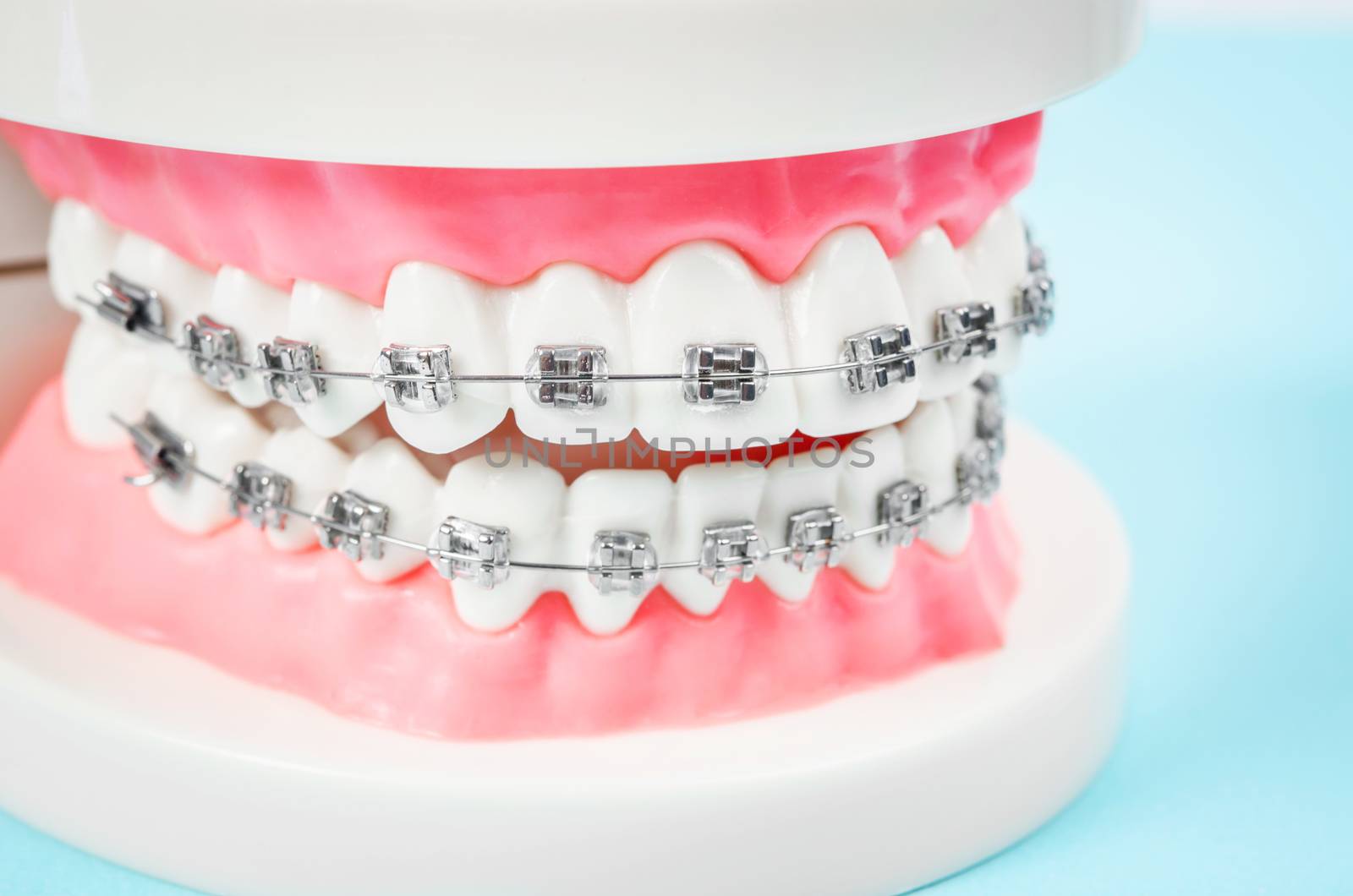 tooth model with metal wire dental braces on blue background.