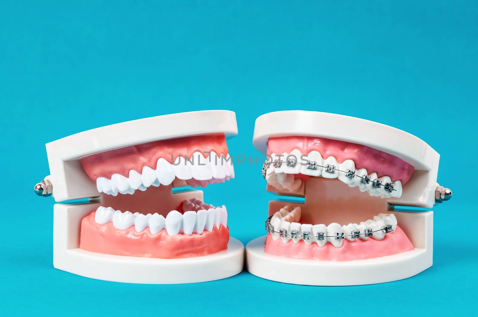 Compare tooth model and tooth model with metal wire dental braces on blue background.