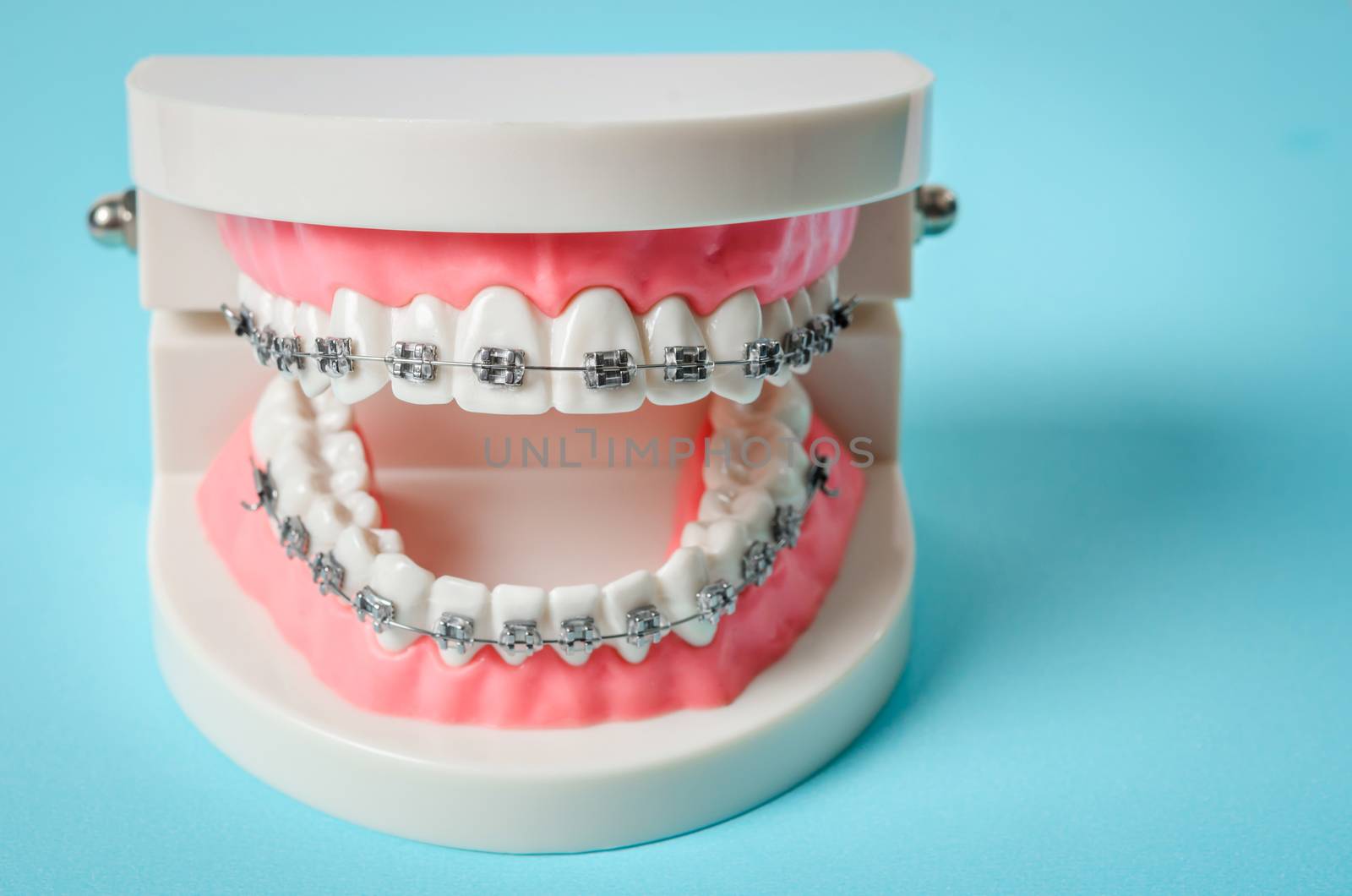 tooth model with metal wire dental braces on blue background.