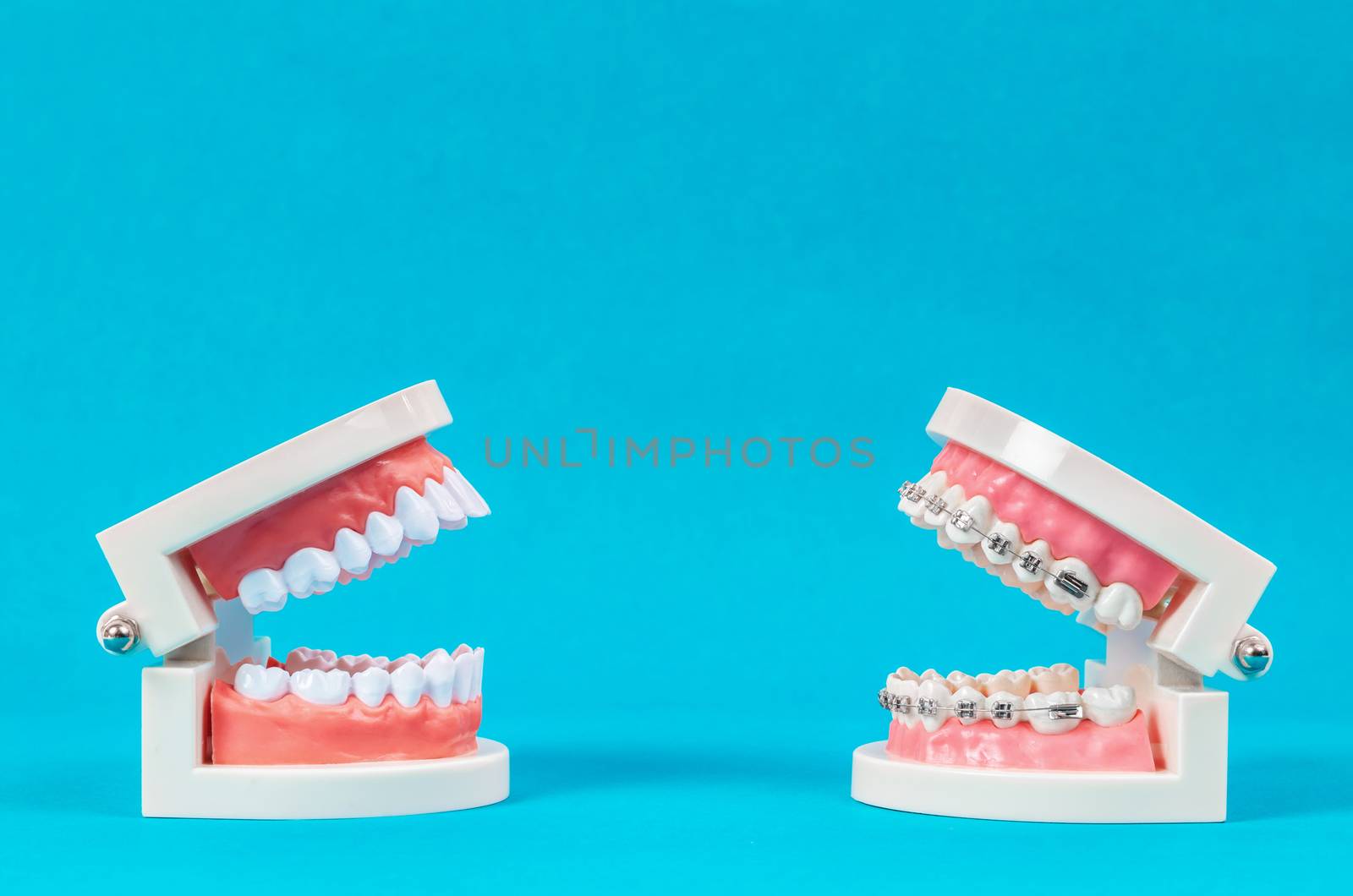 Compare tooth model and tooth model with metal wire dental brace by Gamjai
