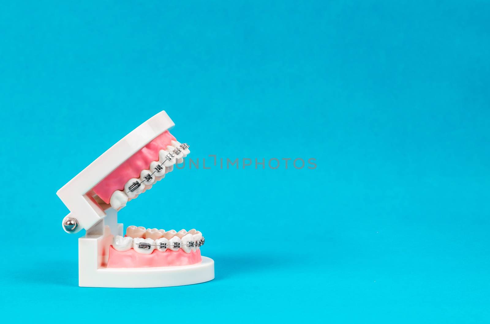 Tooth model with metal wire dental braces. by Gamjai