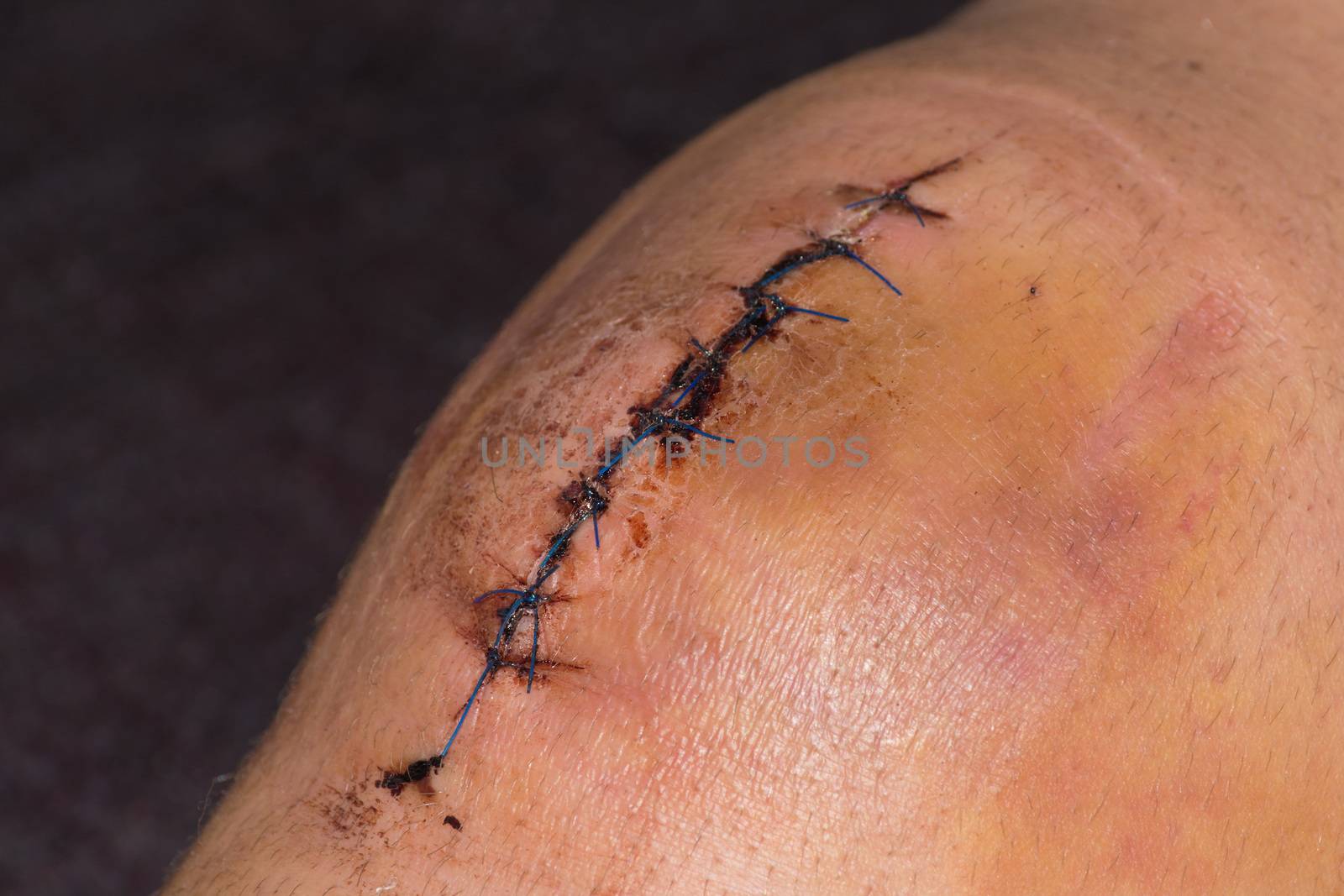 Male knee after surgical operation, knee replacement. Knee surgery in the hospital