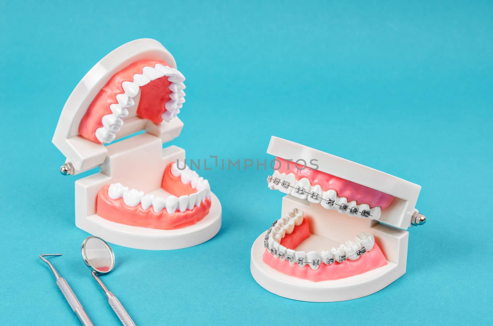 Compare tooth model and tooth model with metal wire dental brace by Gamjai